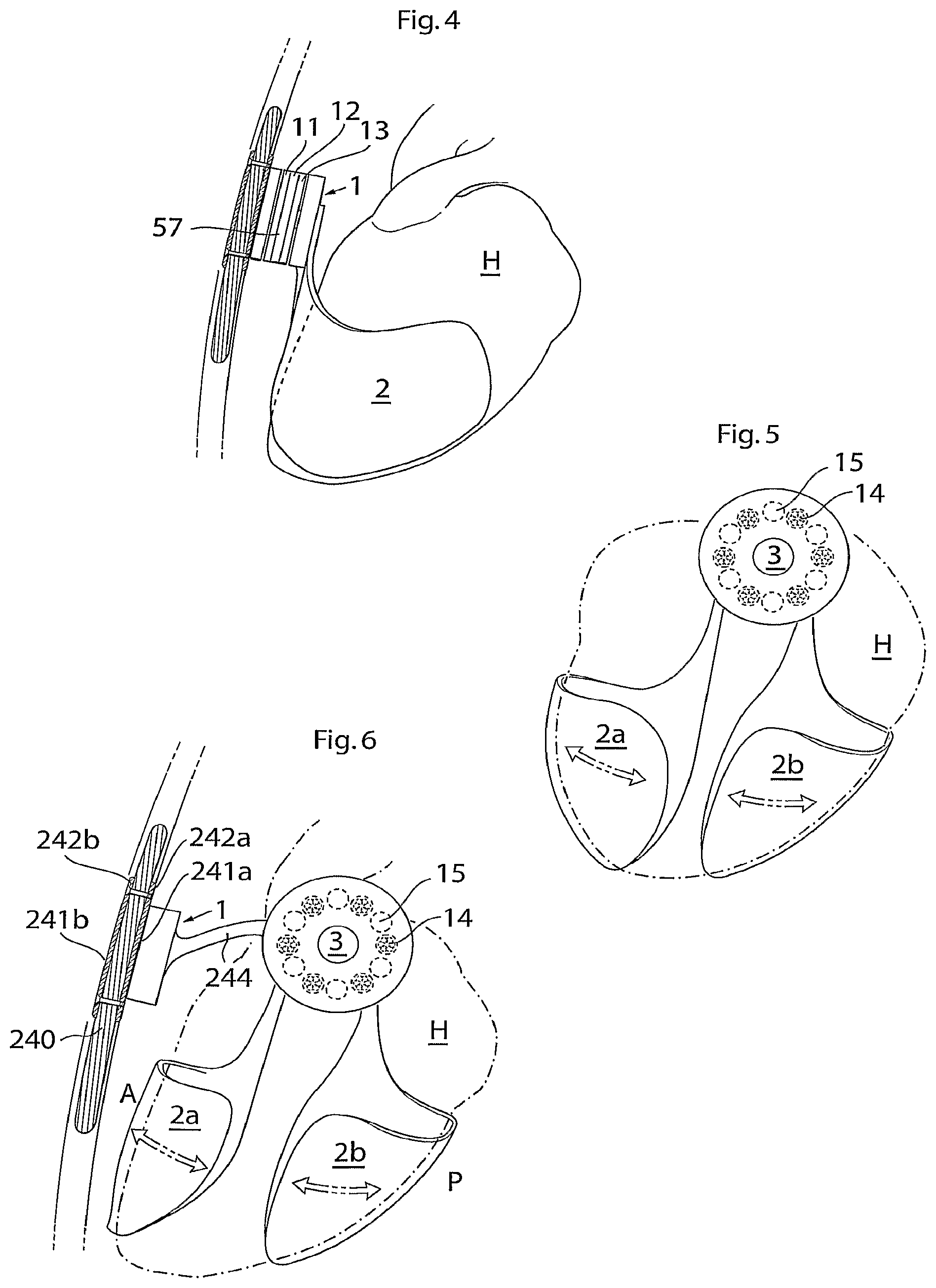 Patent US12102829 Figure 3 – Heart help device, method and system