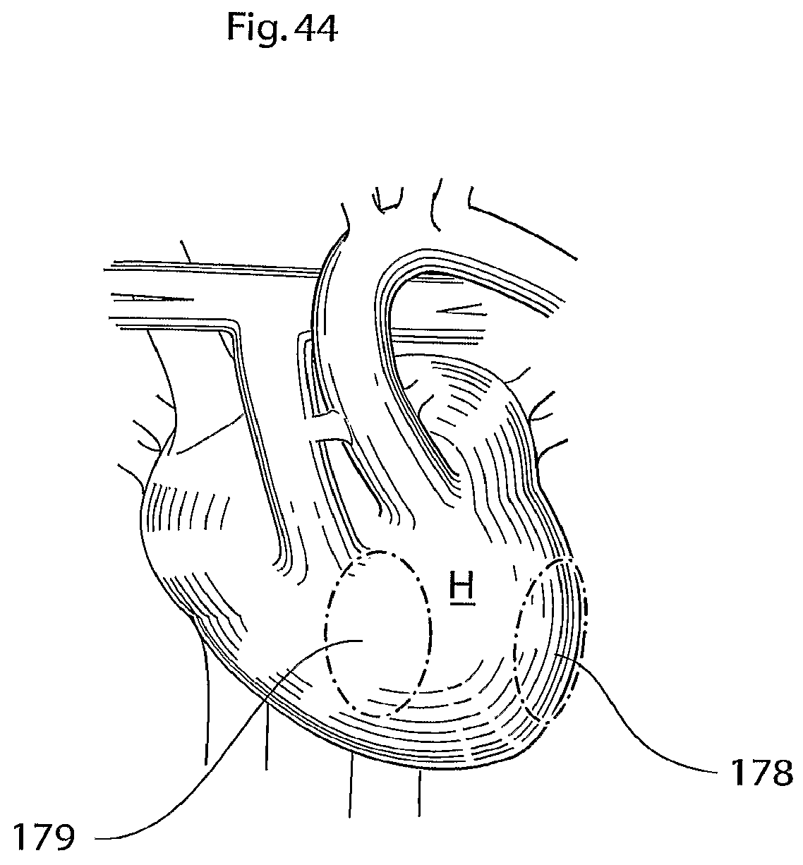 Patent US12102829 Figure 18 – Heart help device, method and system