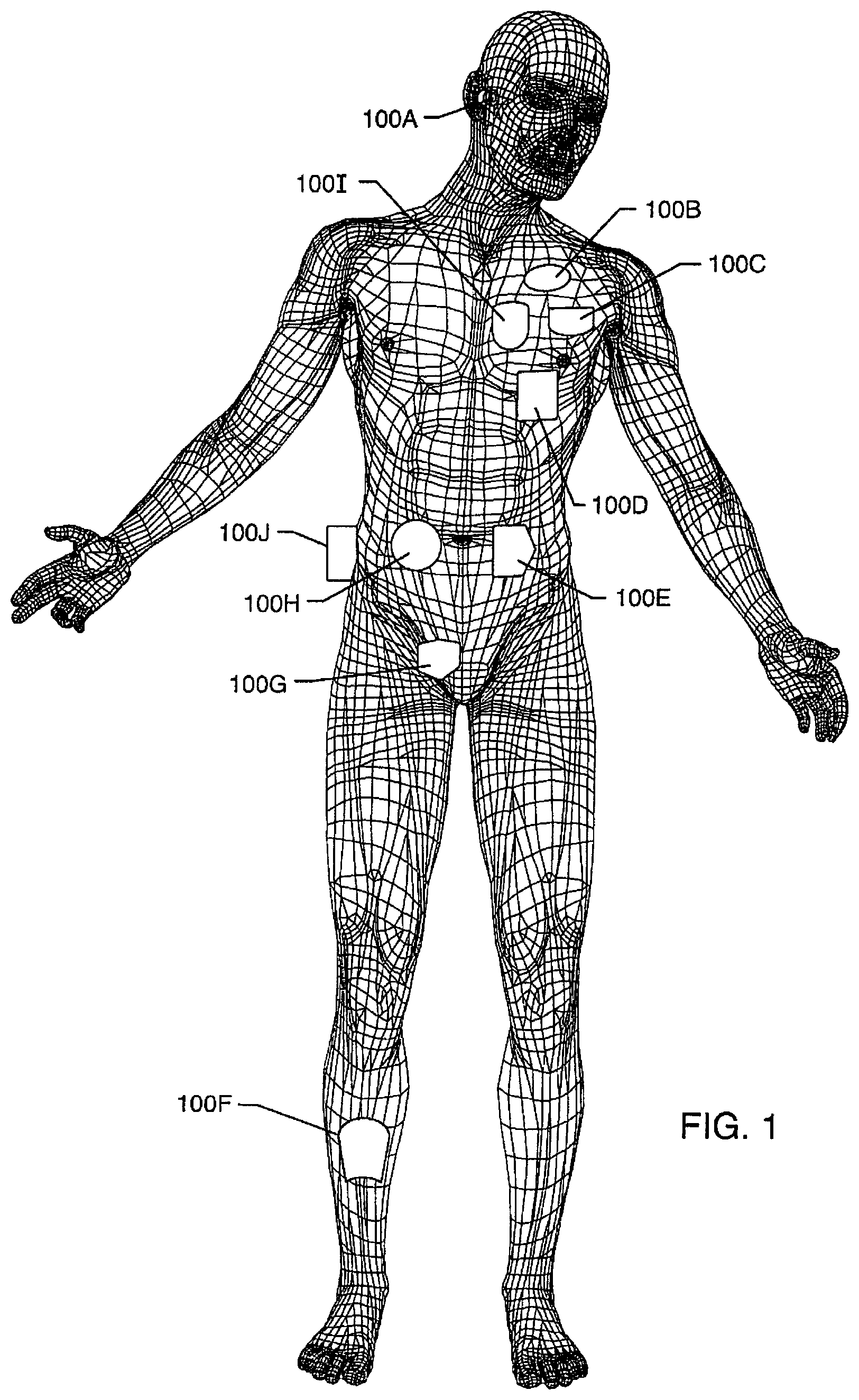 Patent US12102831 — Clinical static strip magnet of alternating polarities to prevent inadvertent actuation of magnet-mode in an active implantable medical device — Figure 1