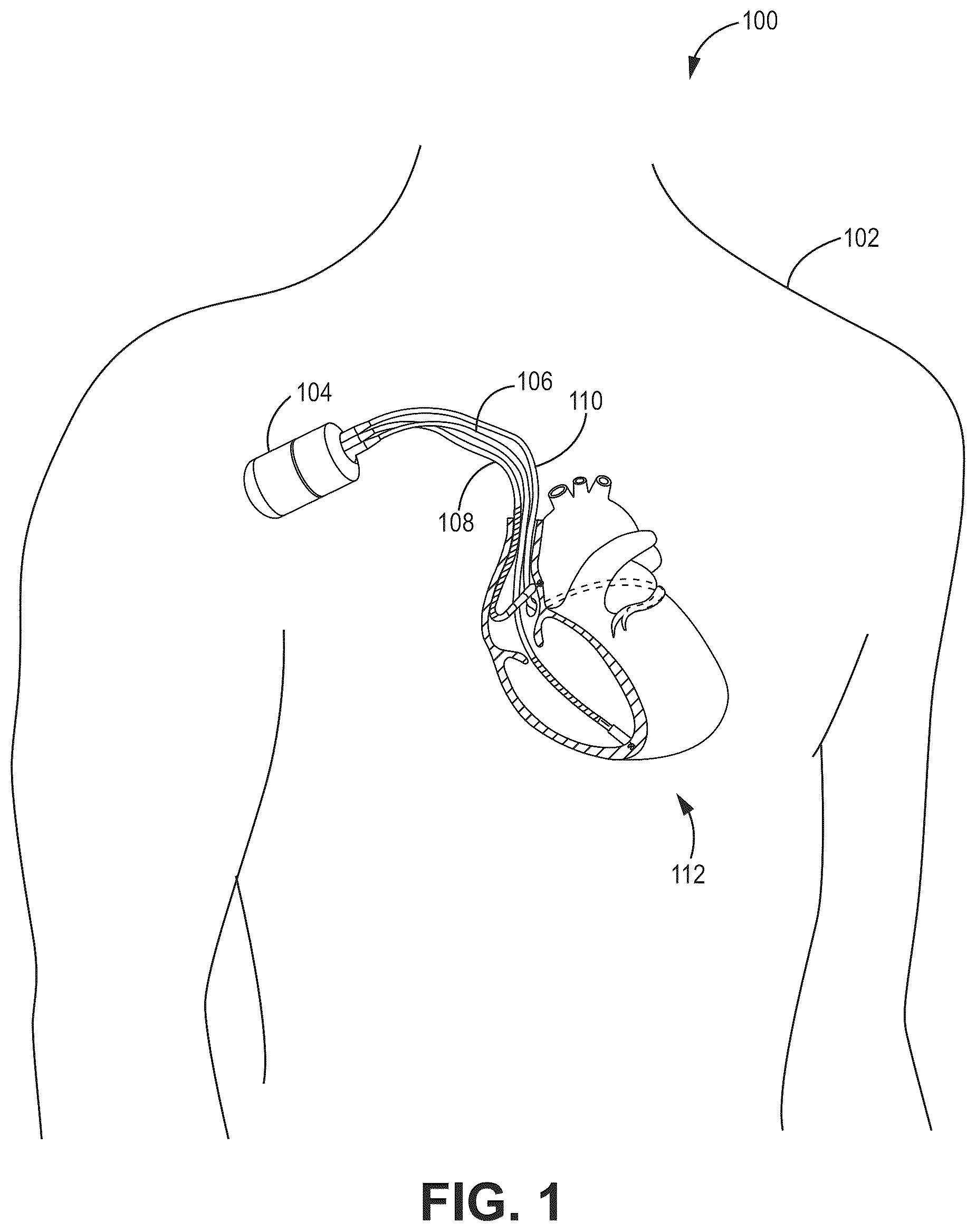Patent US12102832 — Folded headspace insulator — Figure 1
