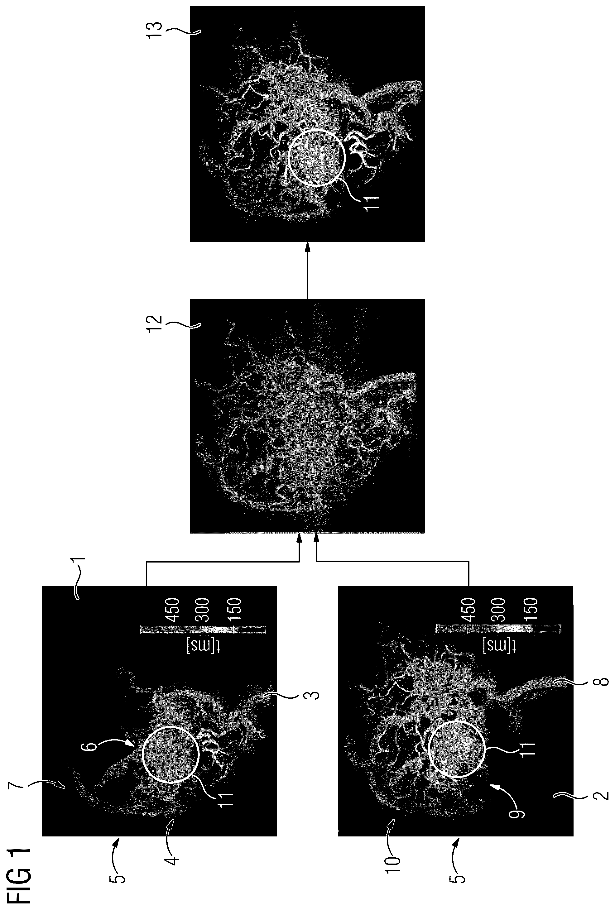 Patent US12106449 Figure 1 – Spatiotemporal fusion of time-resolved angiographic data sets
