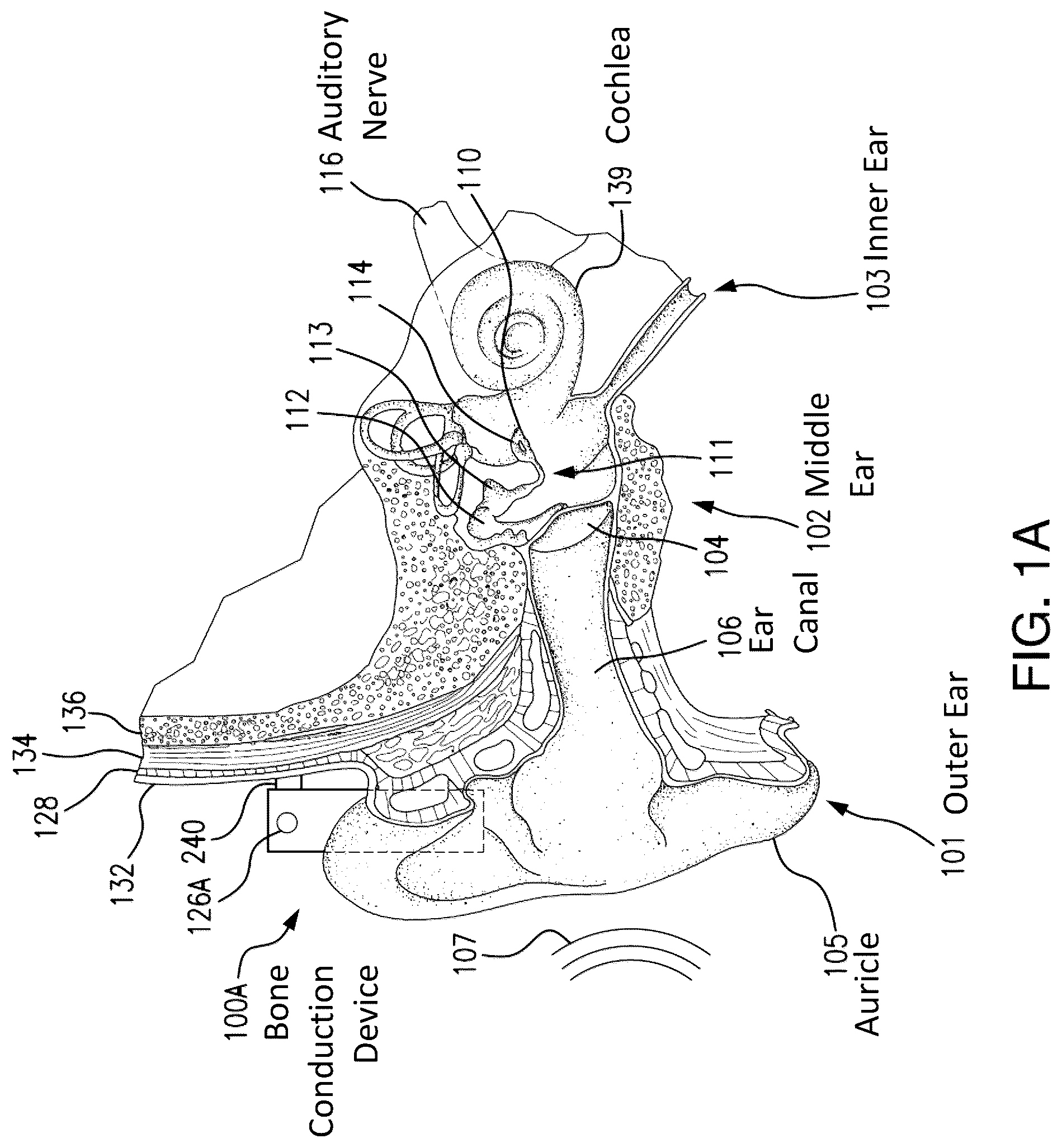 Patent US12108216 — Impact and resonance management — Figure 1