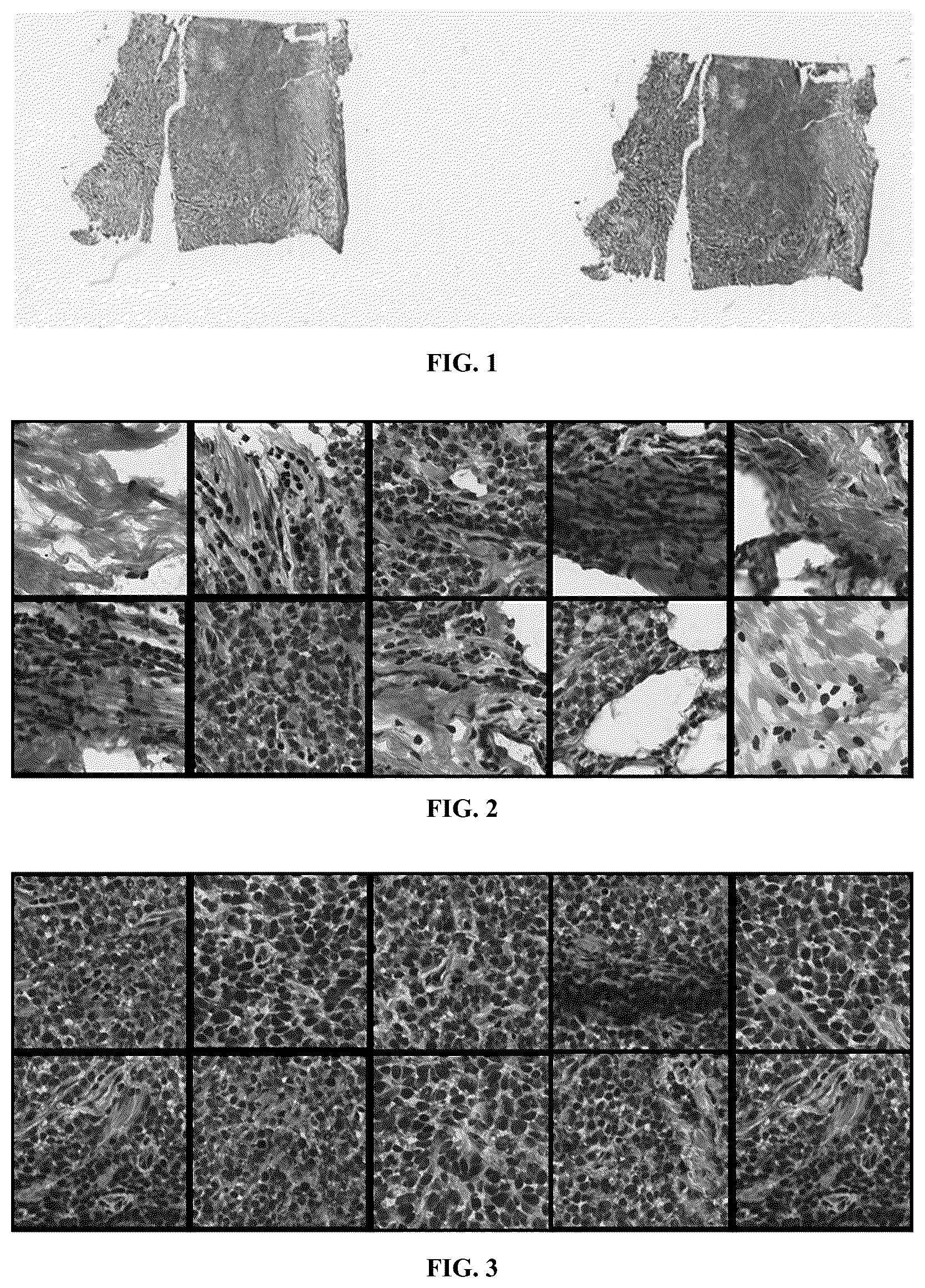 Patent US12112475 Figure 1 – Method and system for predicting tumor mutation burden (TMB) in triple negative breast cancer (TNBC) based on nuclear scores and histopathological whole slide images (WSIs)