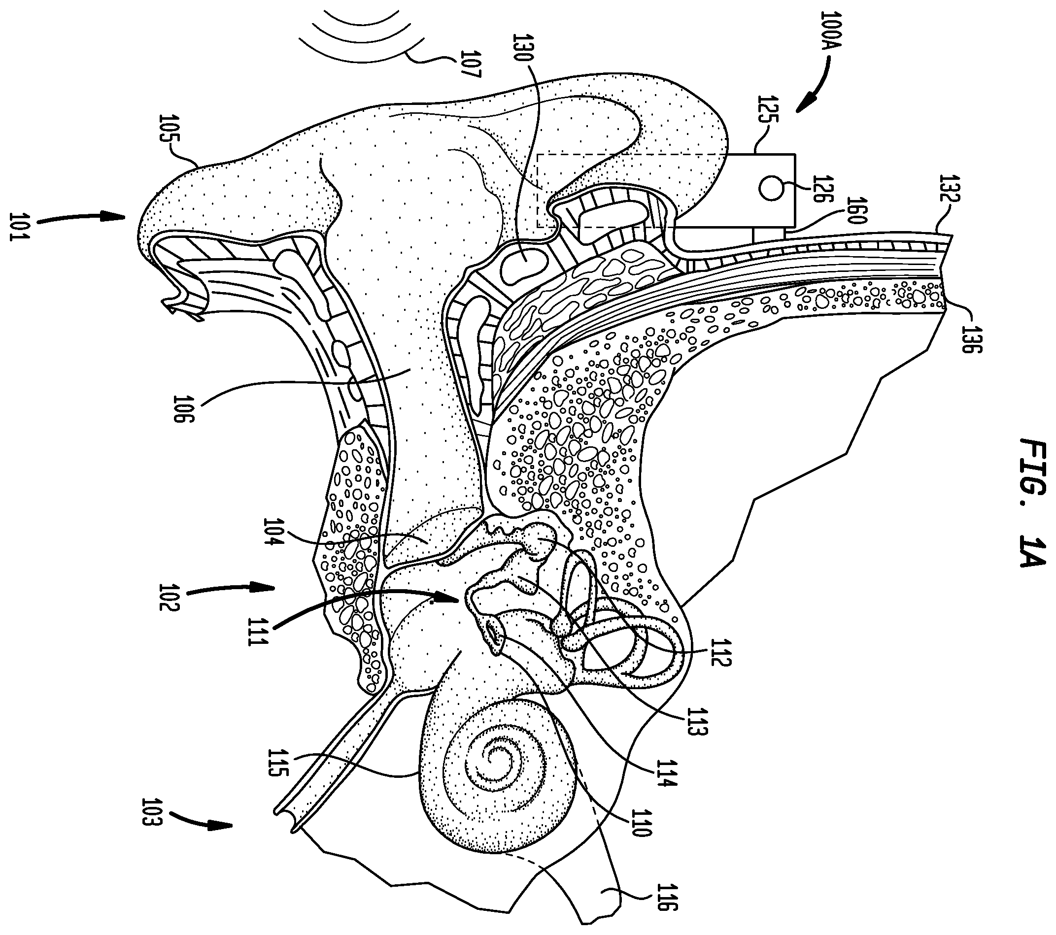 Patent US12126966 — Medical device having an impulse force-resistant component — Figure 1
