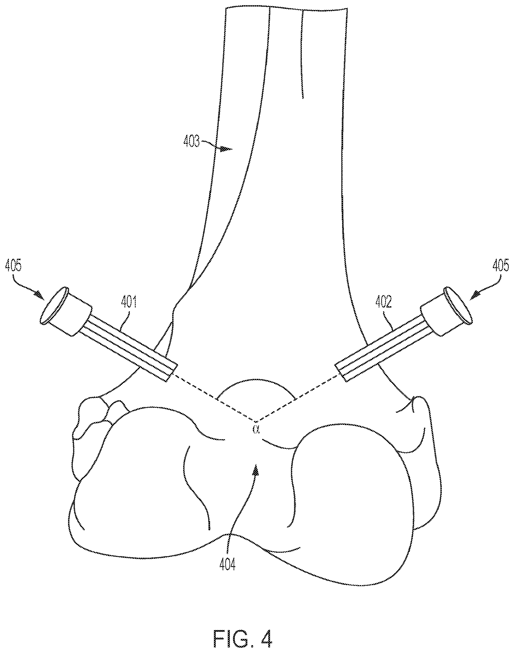 Patent US12137883 Figure 4 – User interface for digital markers in arthroscopy