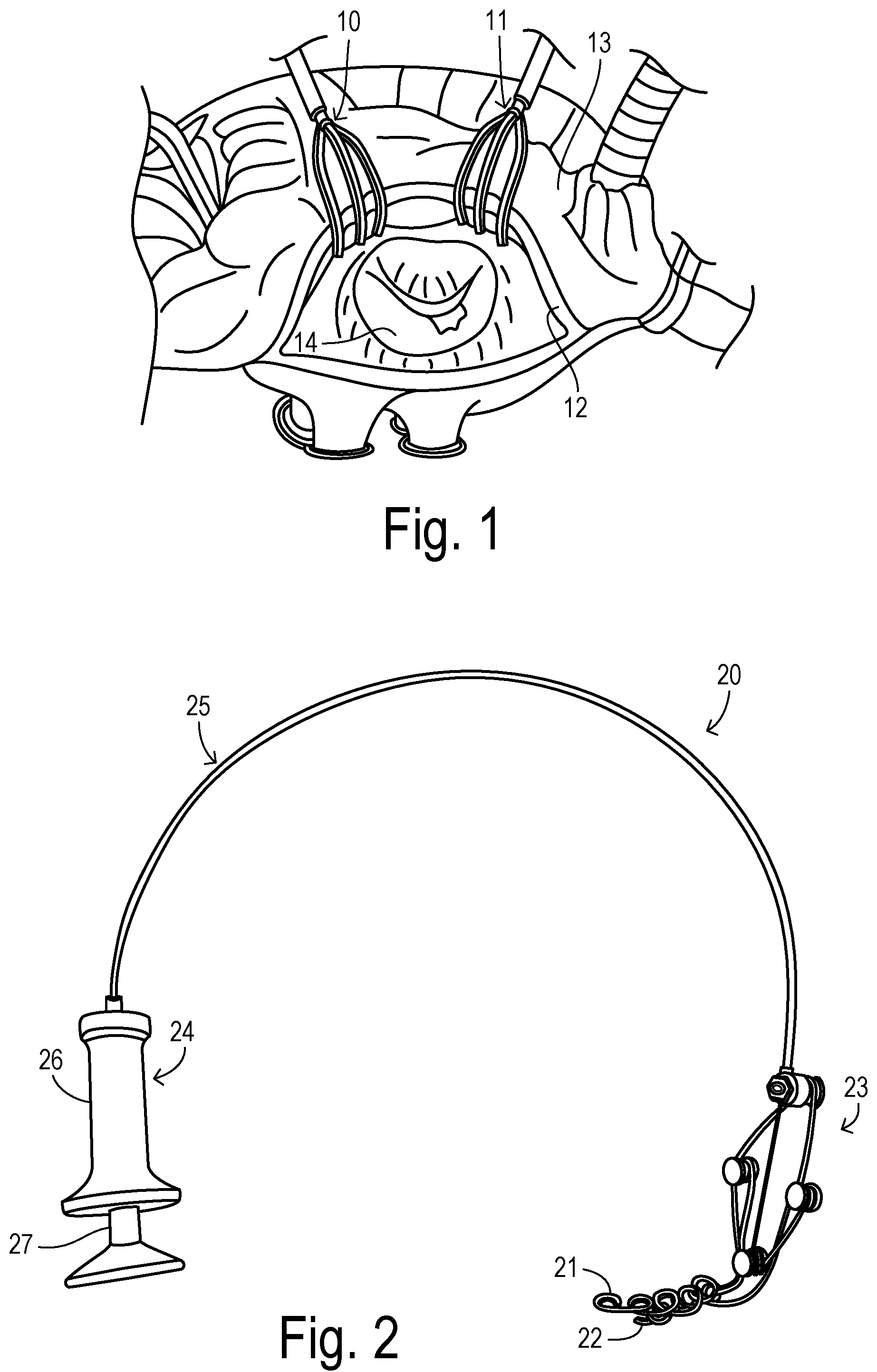 Patent US12137889 — Expansion device for opening valve perimeter in cardiac surgery — Figure 1