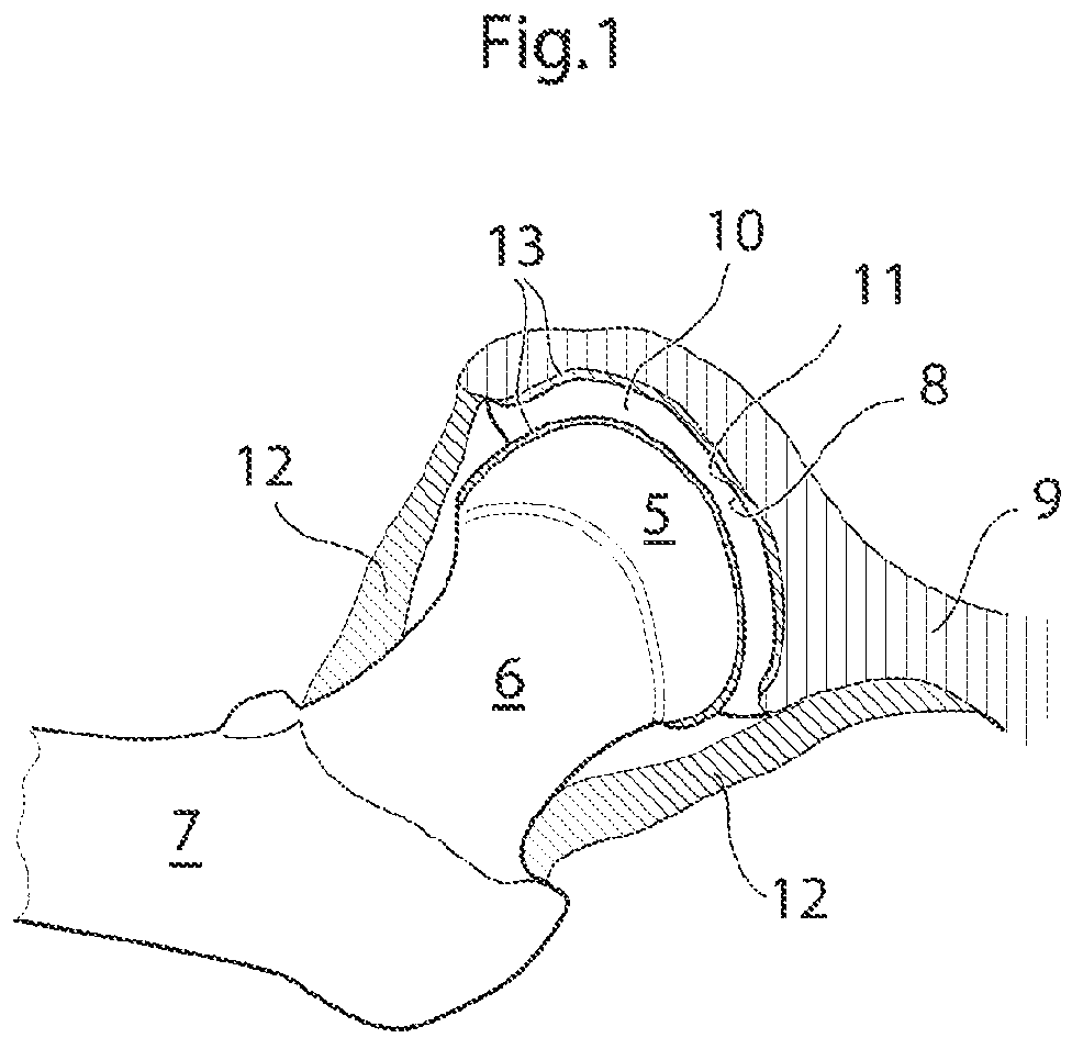 Patent US12137920 Figure 1 – Medical device and method for treatment of hip joint