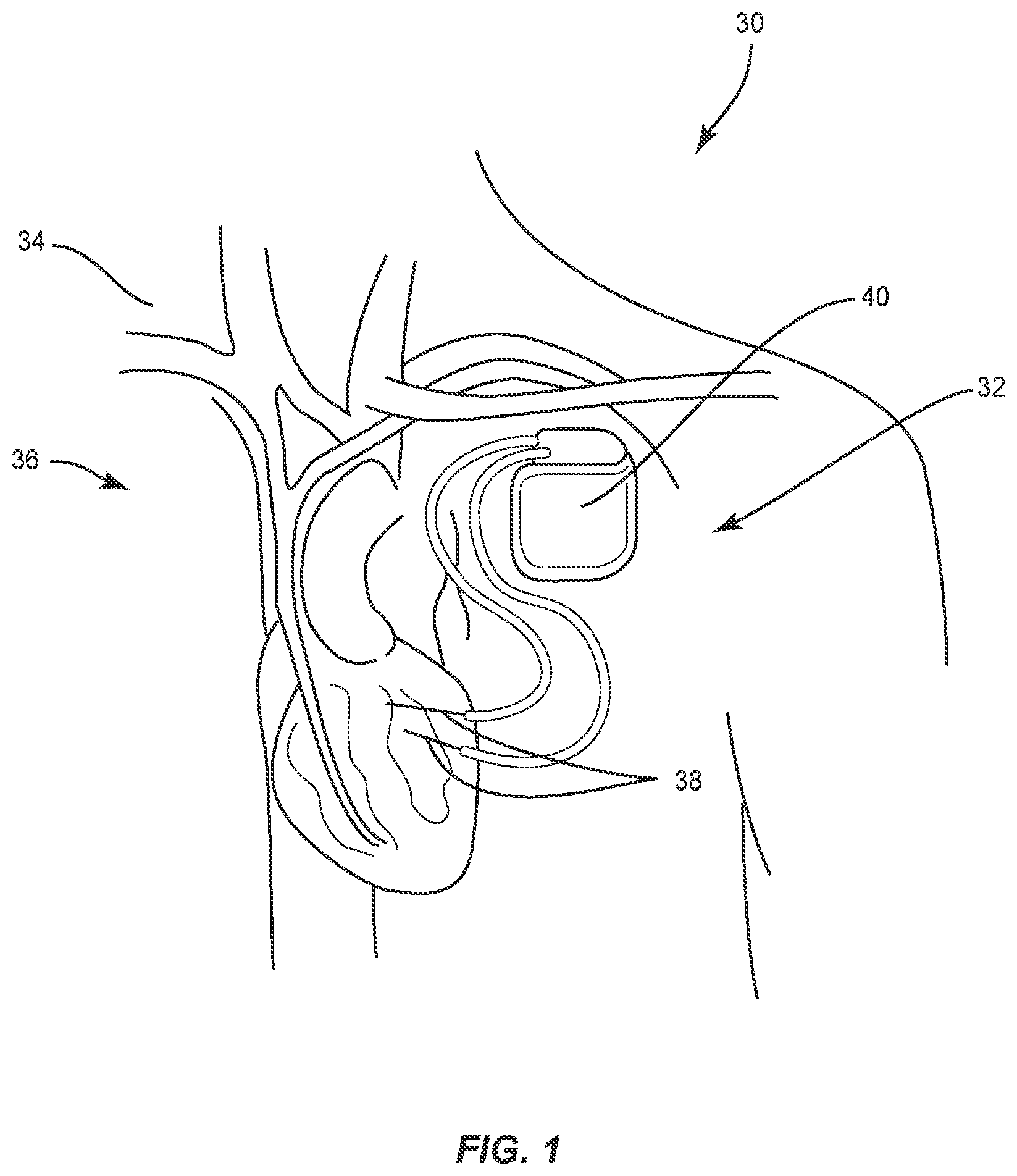 Patent US12137924 Figure 1 – Surgical system and methods