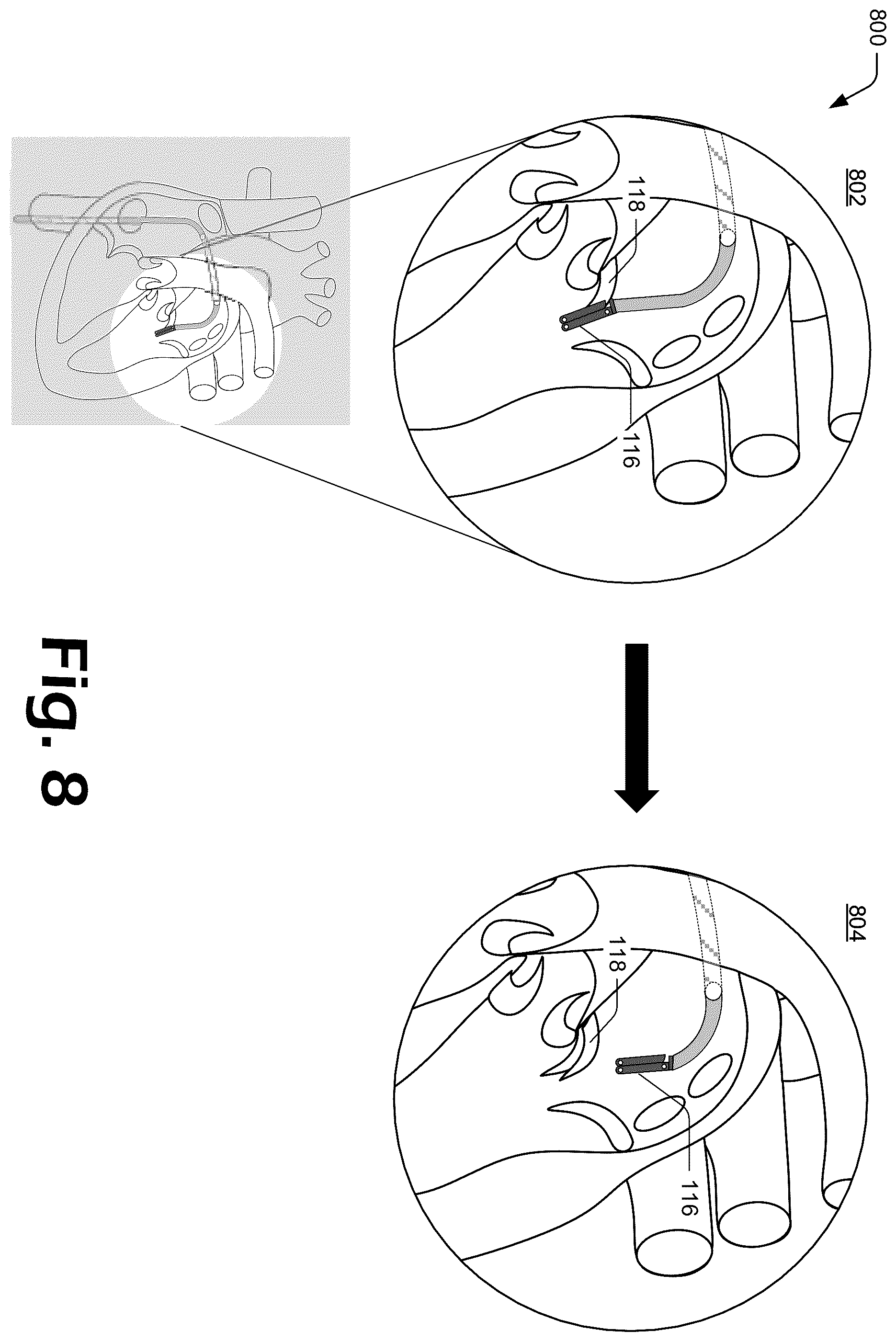 Patent US12137927 Figure 8 – Cutting grasper for valve leaflet laceration