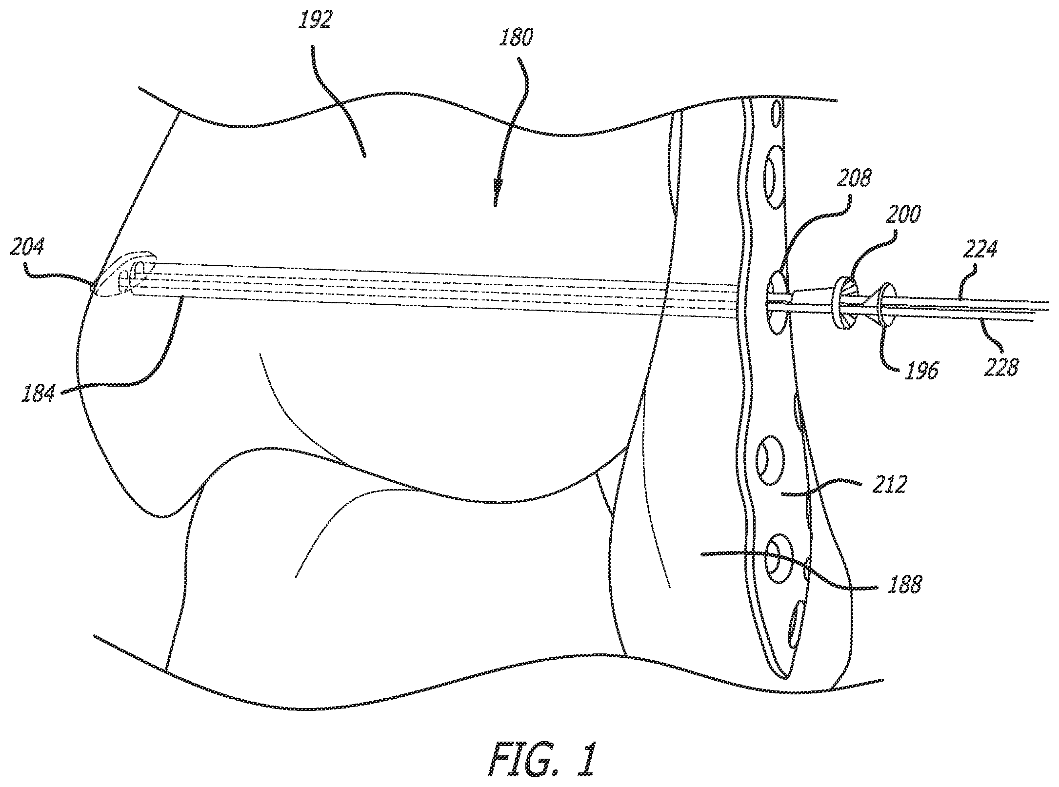 Patent US12137942 — Syndesmosis treatment construct — Figure 1