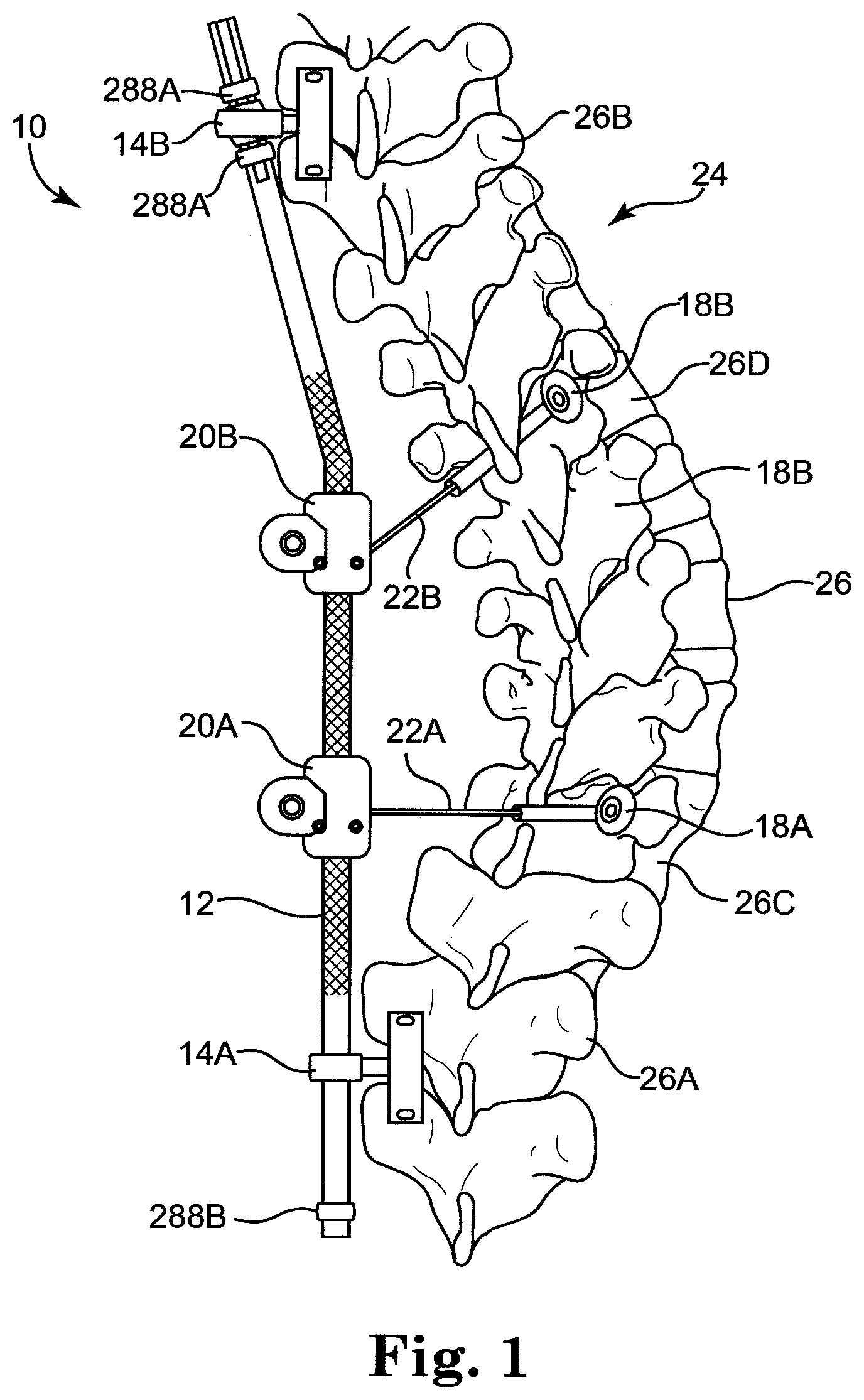 Patent US12137943 — Semi-constrained anchoring system — Figure 1