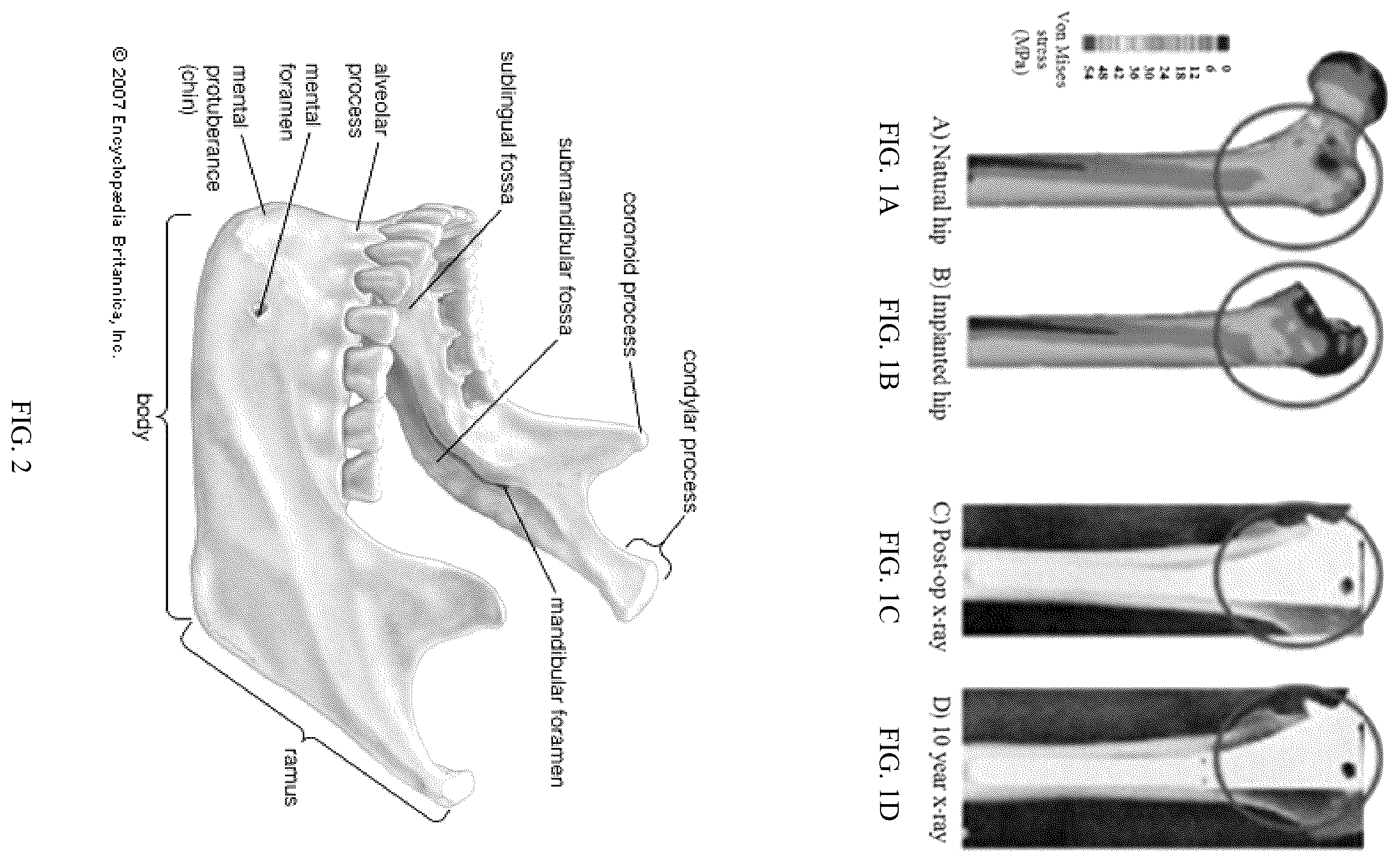 Patent US12137952 — Methods, devices, and manufacture of the devices for musculoskeletal reconstructive surgery — Figure 1
