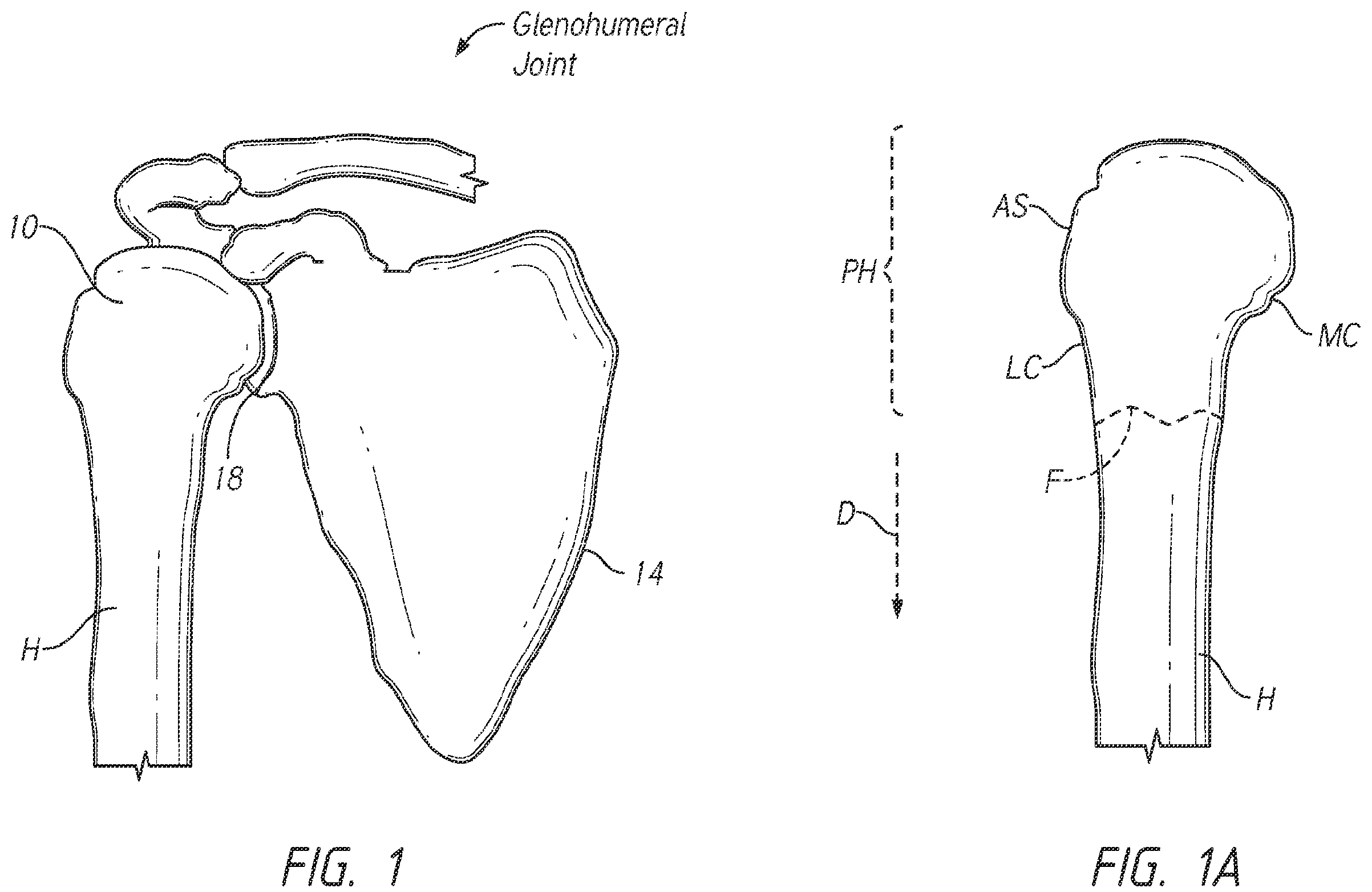 Patent US12137953 — Humeral fixation plates — Figure 1