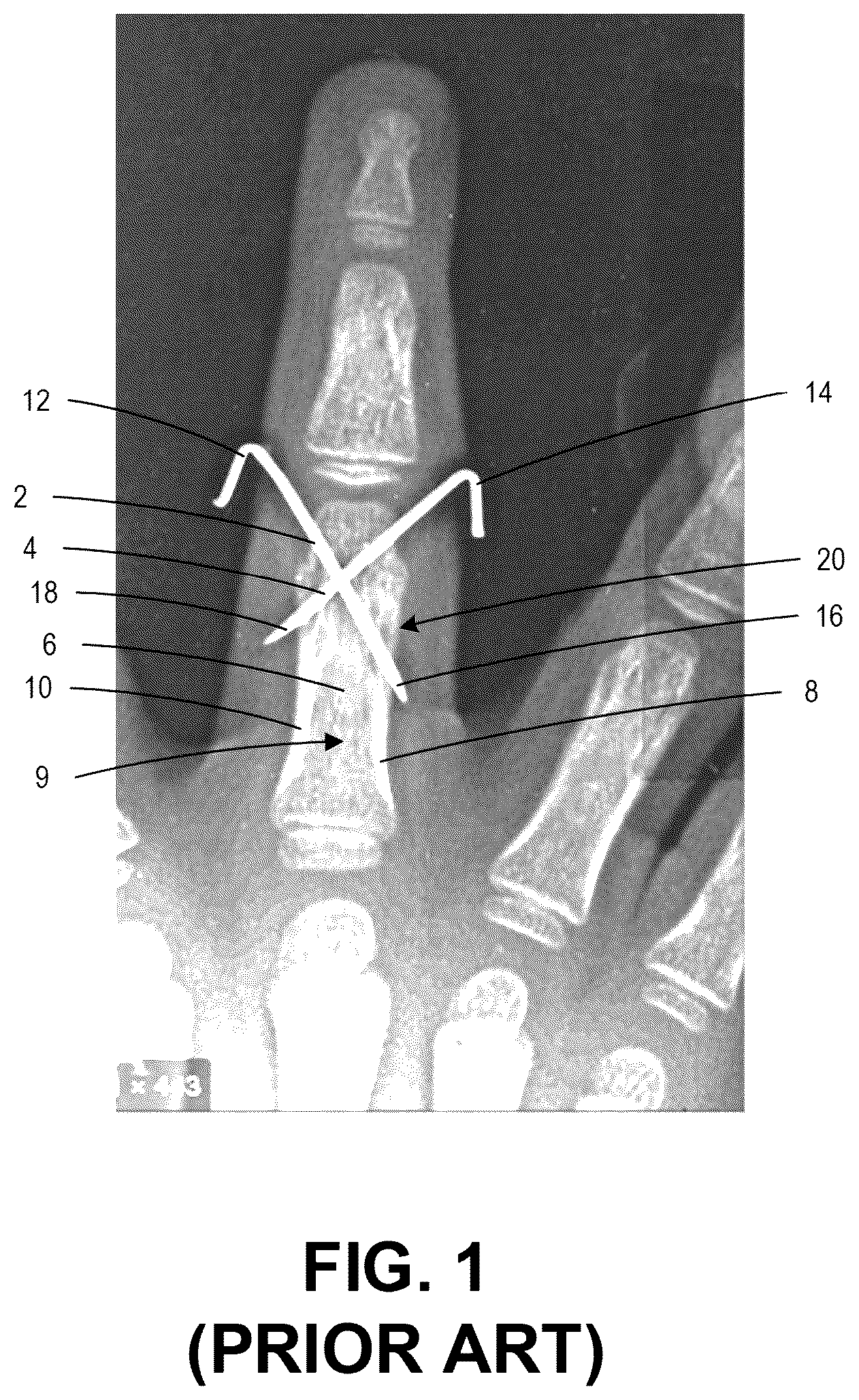Patent US12137956 — Orthopedic implants and instruments for delivering the same — Figure 1