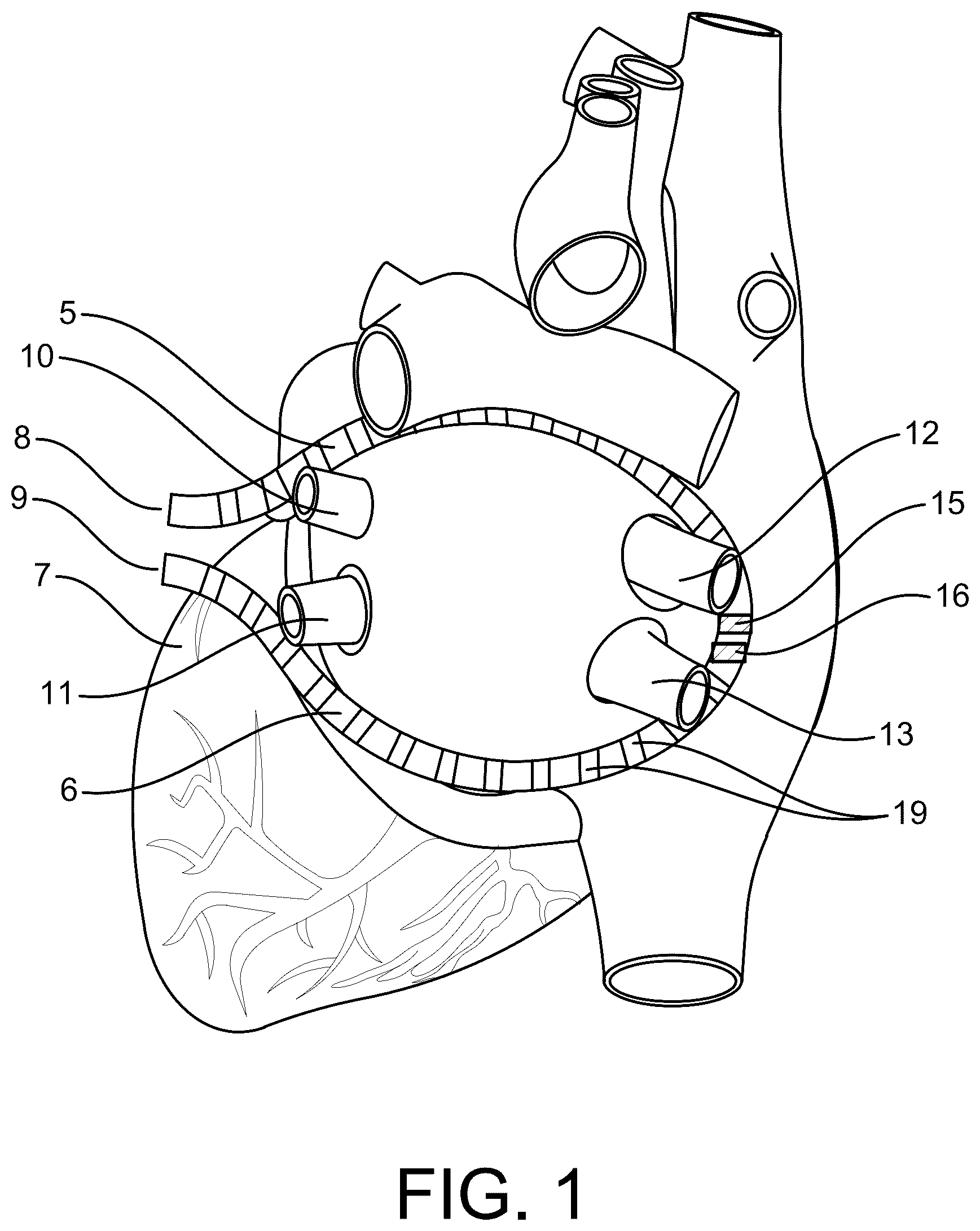 Patent US12137968 — Methods and apparatus for multi-catheter tissue ablation — Figure 1