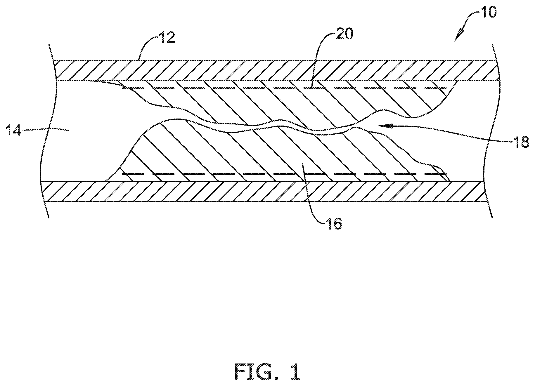 Patent US12137970 — Devices and methods for inducing ablation in or around occluded implants — Figure 1