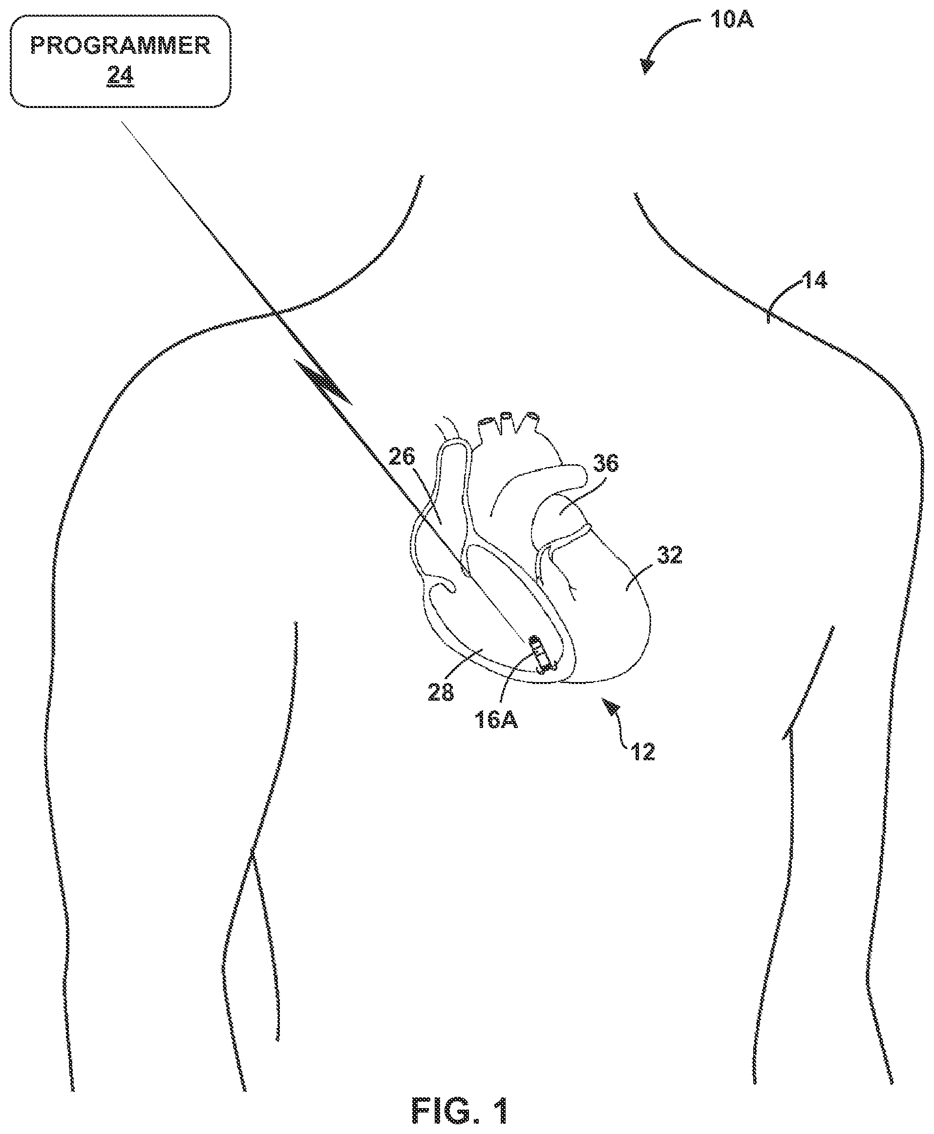 Patent US12157003 — Implantable medical device fixation — Figure 1