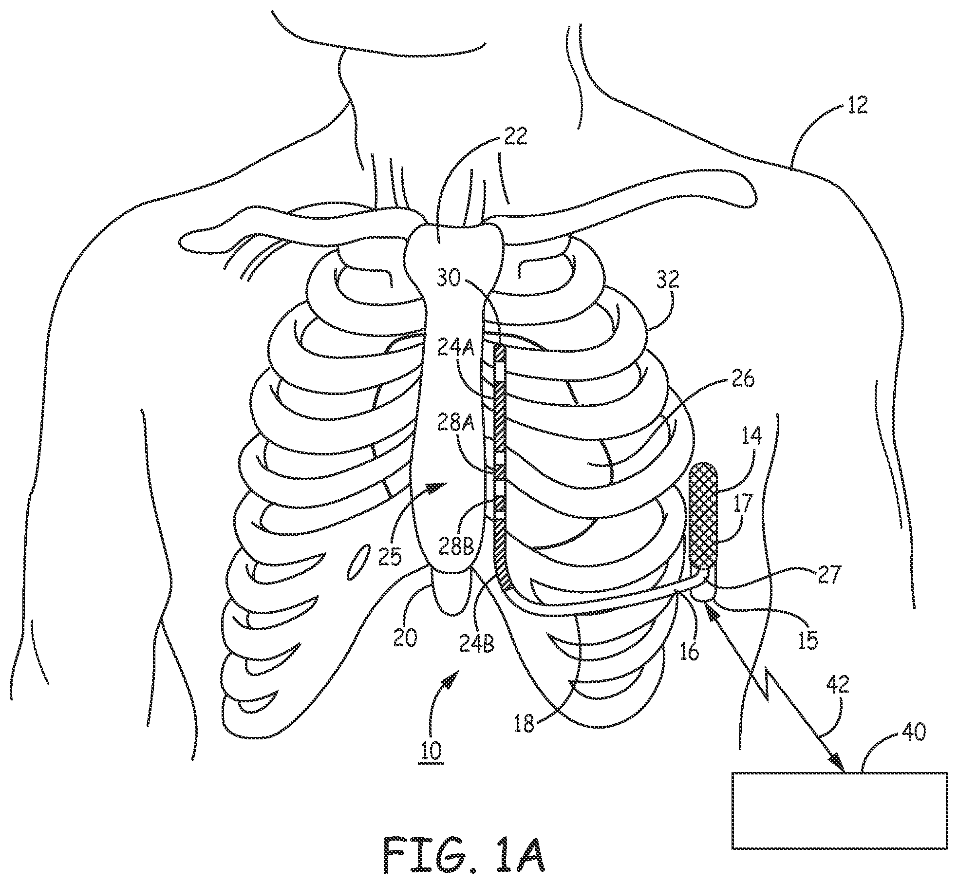 Patent US12157009 — Extra-cardiovascular pacing by an implantable cardioverter defibrillator — Figure 1