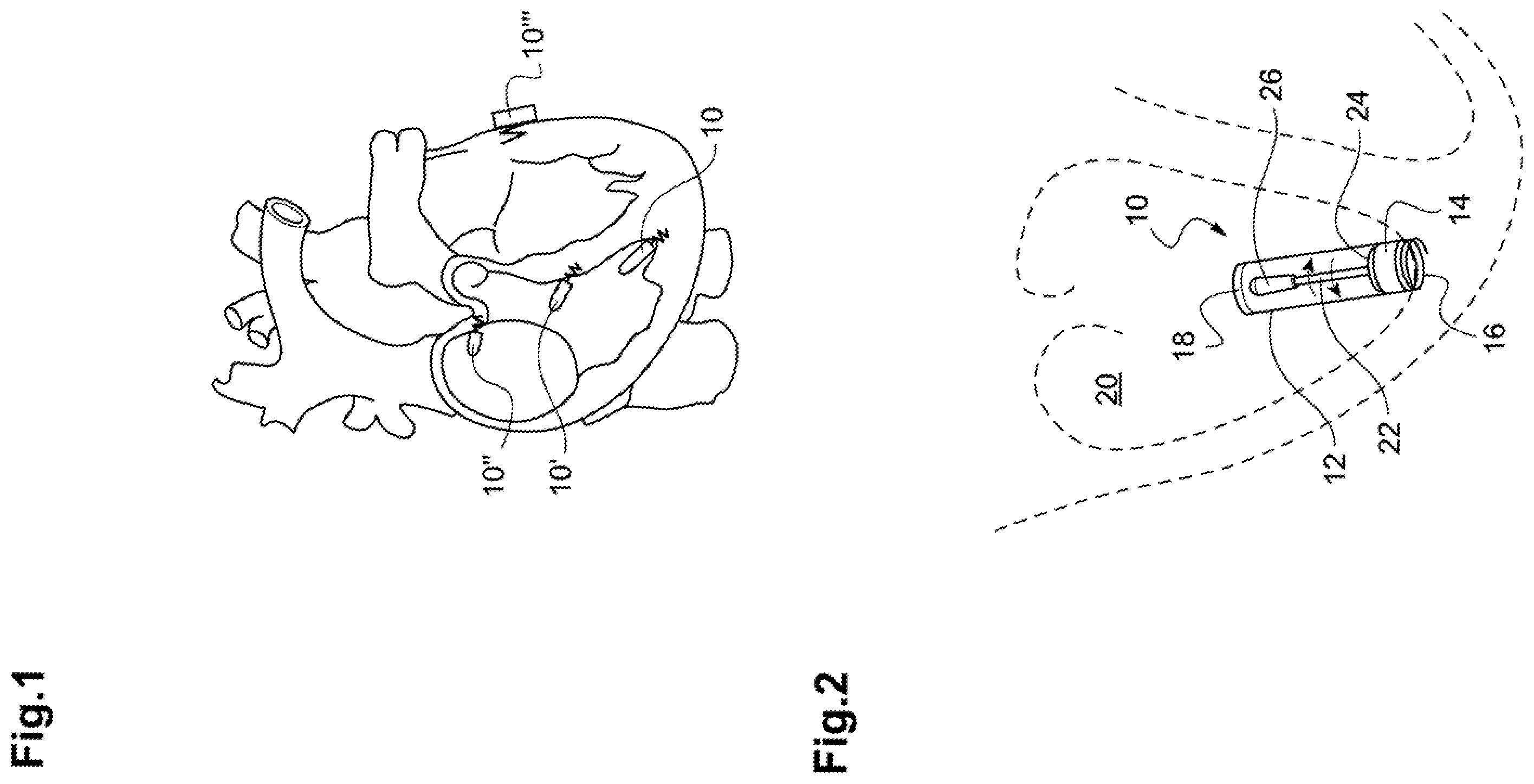 Patent US12157010 — Energy harvesting module with compact-construction piezoelectric transducer, in particular for powering a leadless autonomous cardiaccapsule — Figure 1