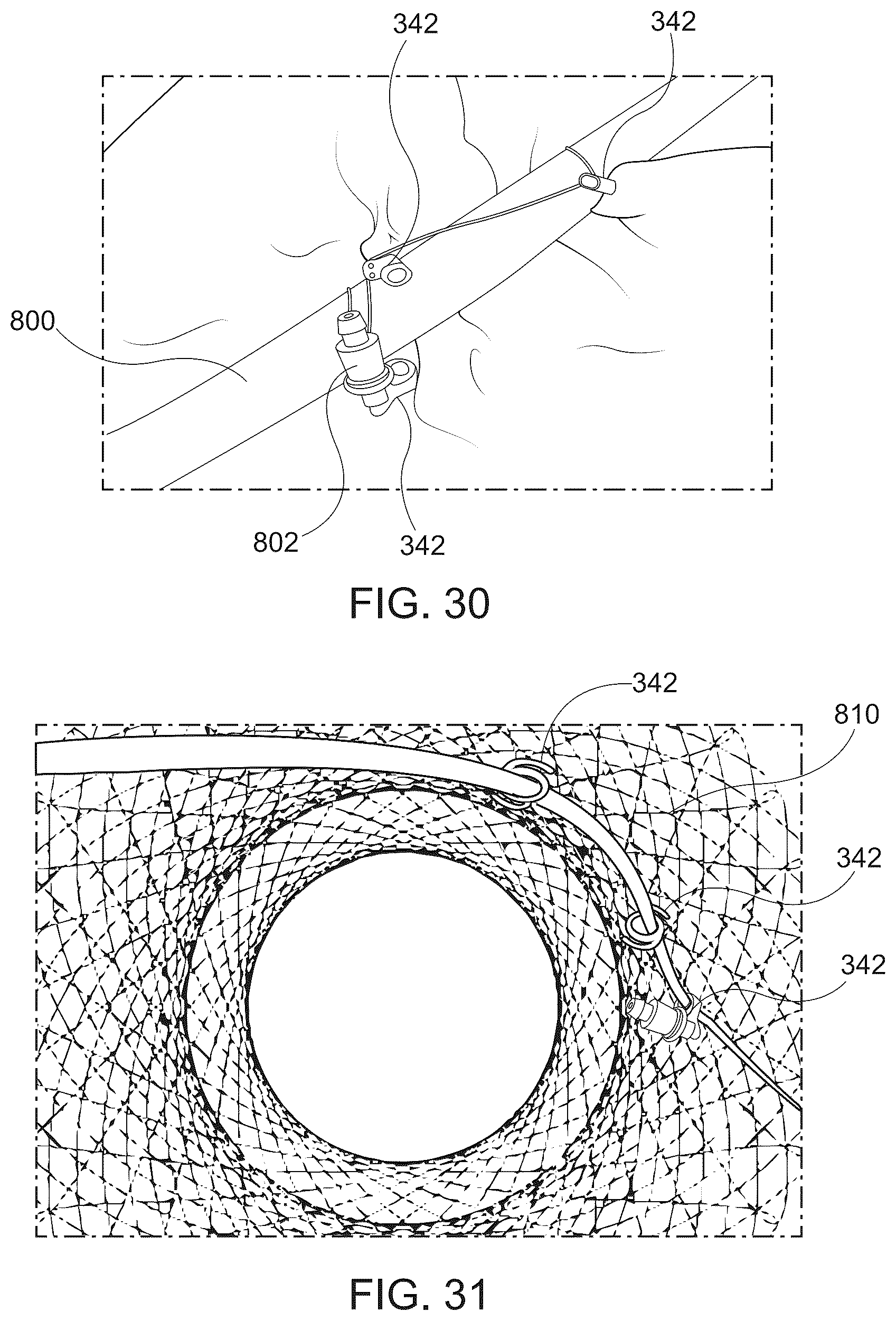 Patent US12167844 Figure 16 – Endoscopic tissue approximation system and methods
