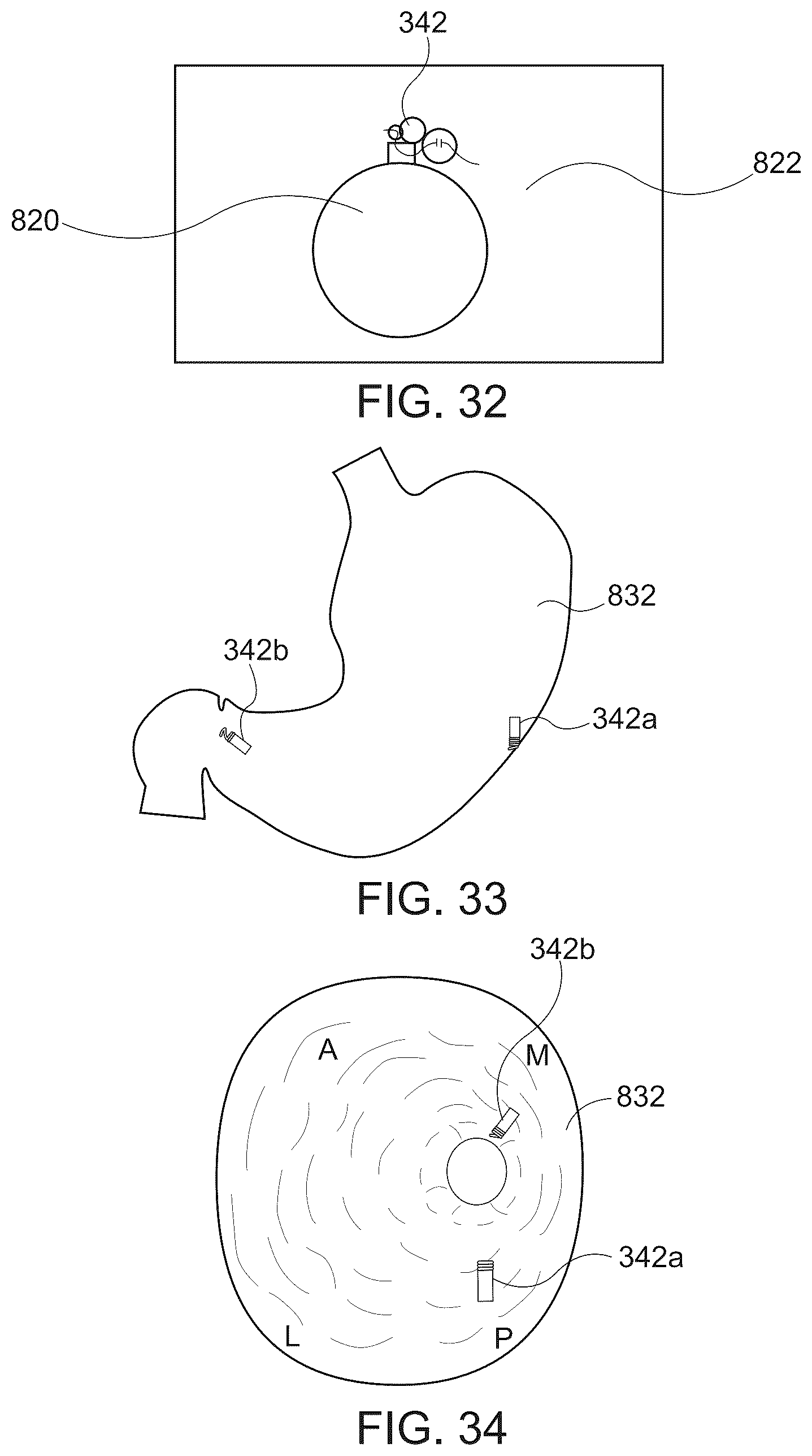 Patent US12167844 Figure 17 – Endoscopic tissue approximation system and methods