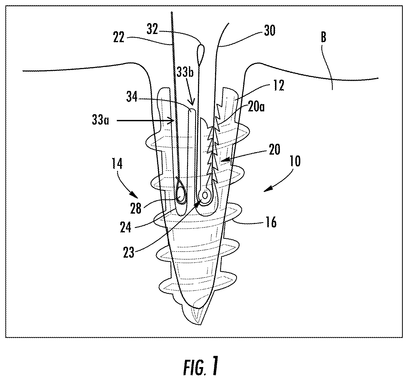 Patent US12167845 Figure 1 – Knotless suture anchor with internal suture locking mechanism