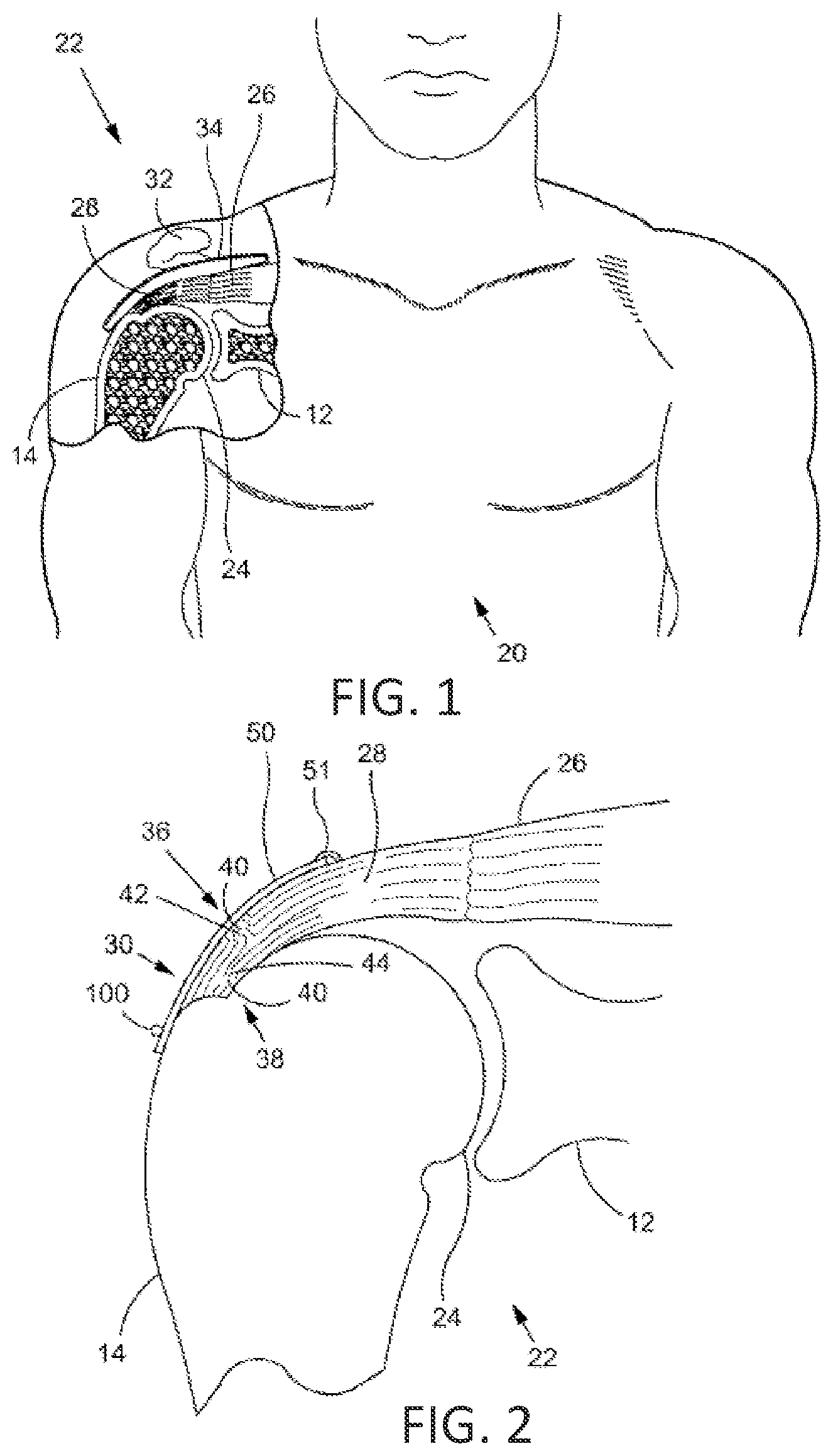 Patent US12167848 — Bone anchor delivery system — Figure 1
