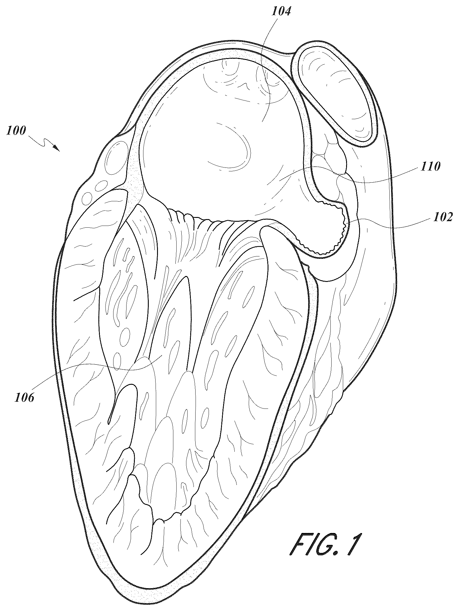 Patent US12167856 — Devices and methods for excluding the left atrial appendage — Figure 1