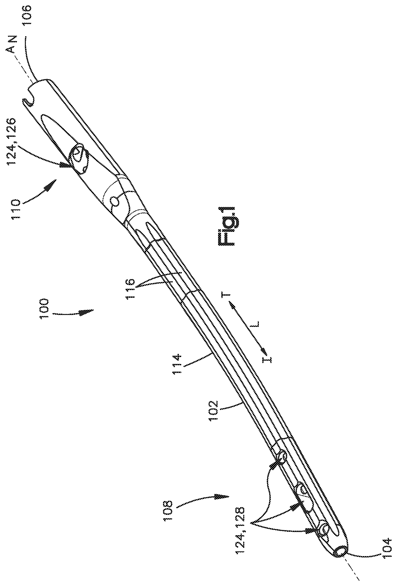 Patent US12167859 Figure 1 – Intramedullary nail with wire or magnet for targeting of a bone-anchor locking hole