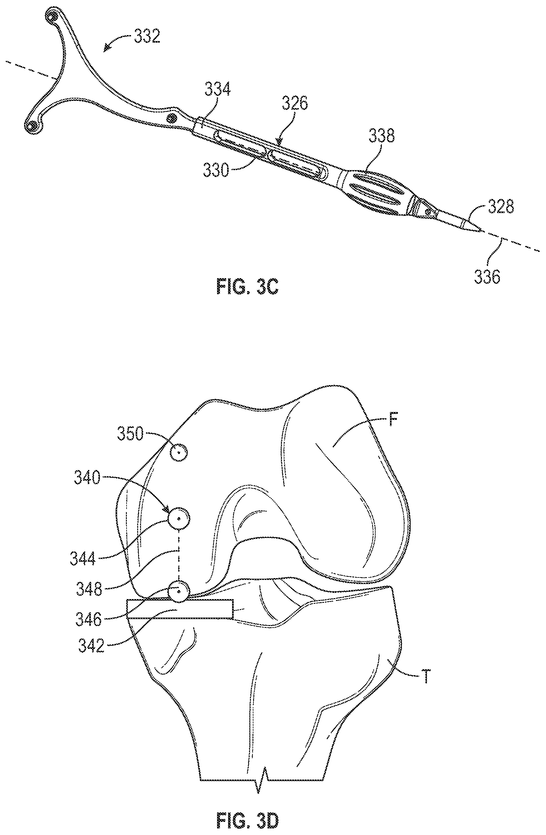 Patent US12167860 Figure 4 – Devices and methods for posterior resection in robotically assisted partial knee arthroplasties