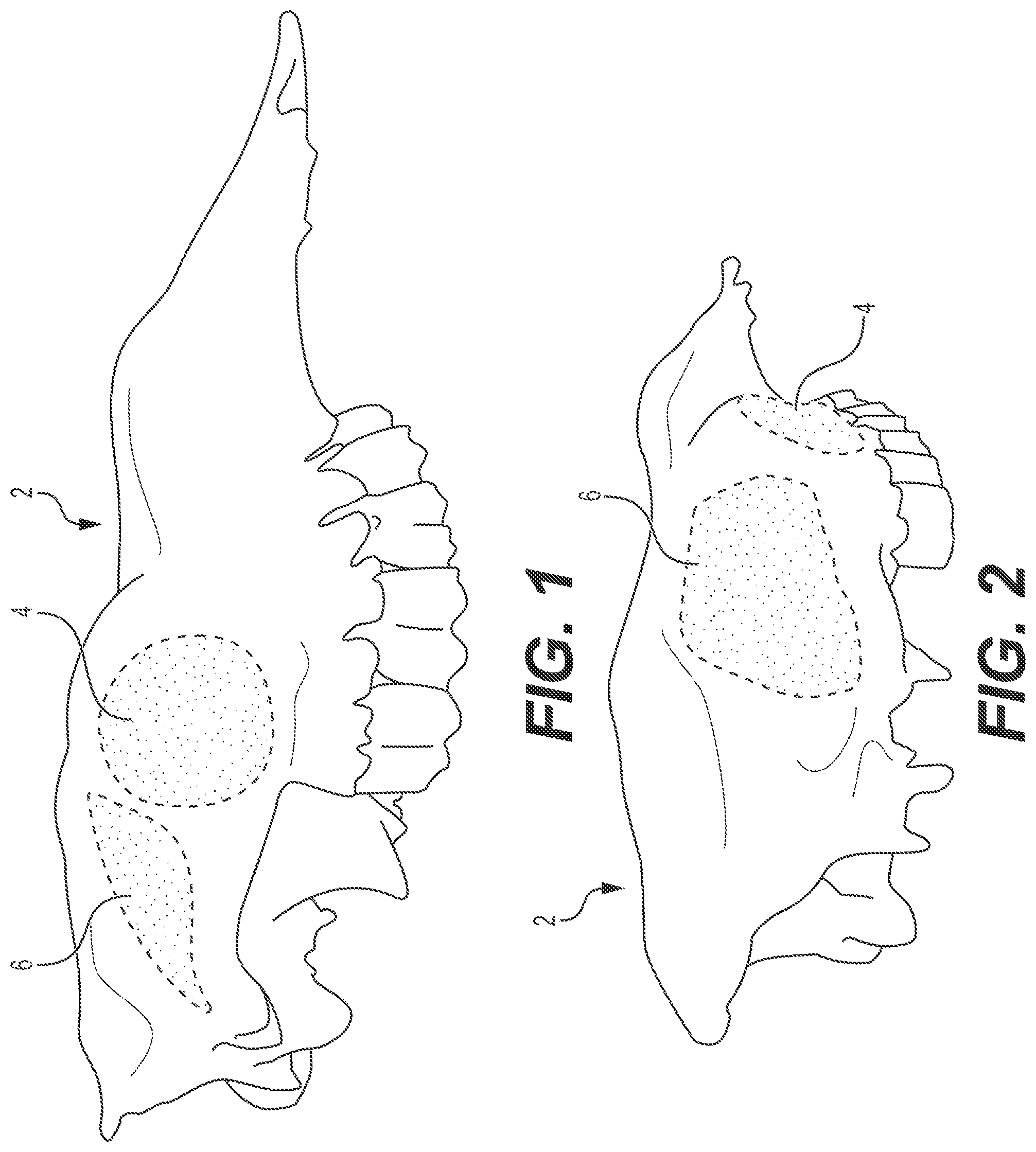 Patent US12167868 — Enucleation-exenteration approach of the camel eye via the supraorbital fossa — Figure 1