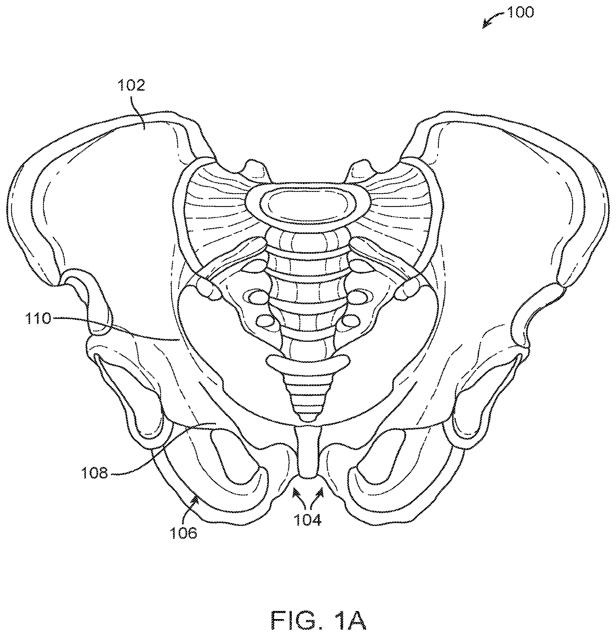 Patent US12167877 — Shape adaptable intramedullary fixation device — Figure 1