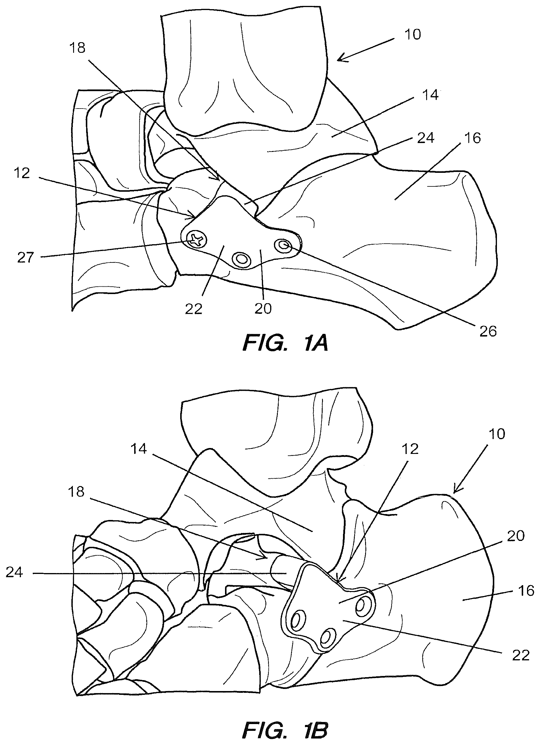 Patent US12167878 — Subtalar plate implant — Figure 1