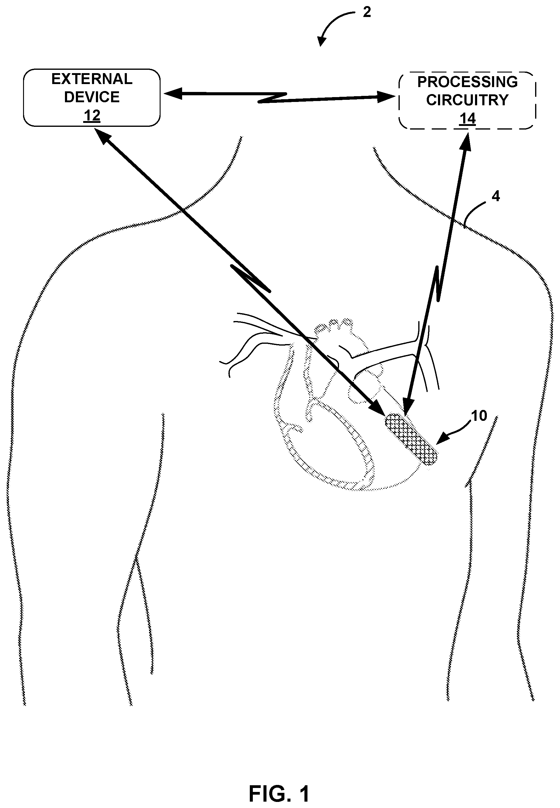 Patent US12167908 — Dynamic bio impedance range adjustment for a medical device — Figure 1
