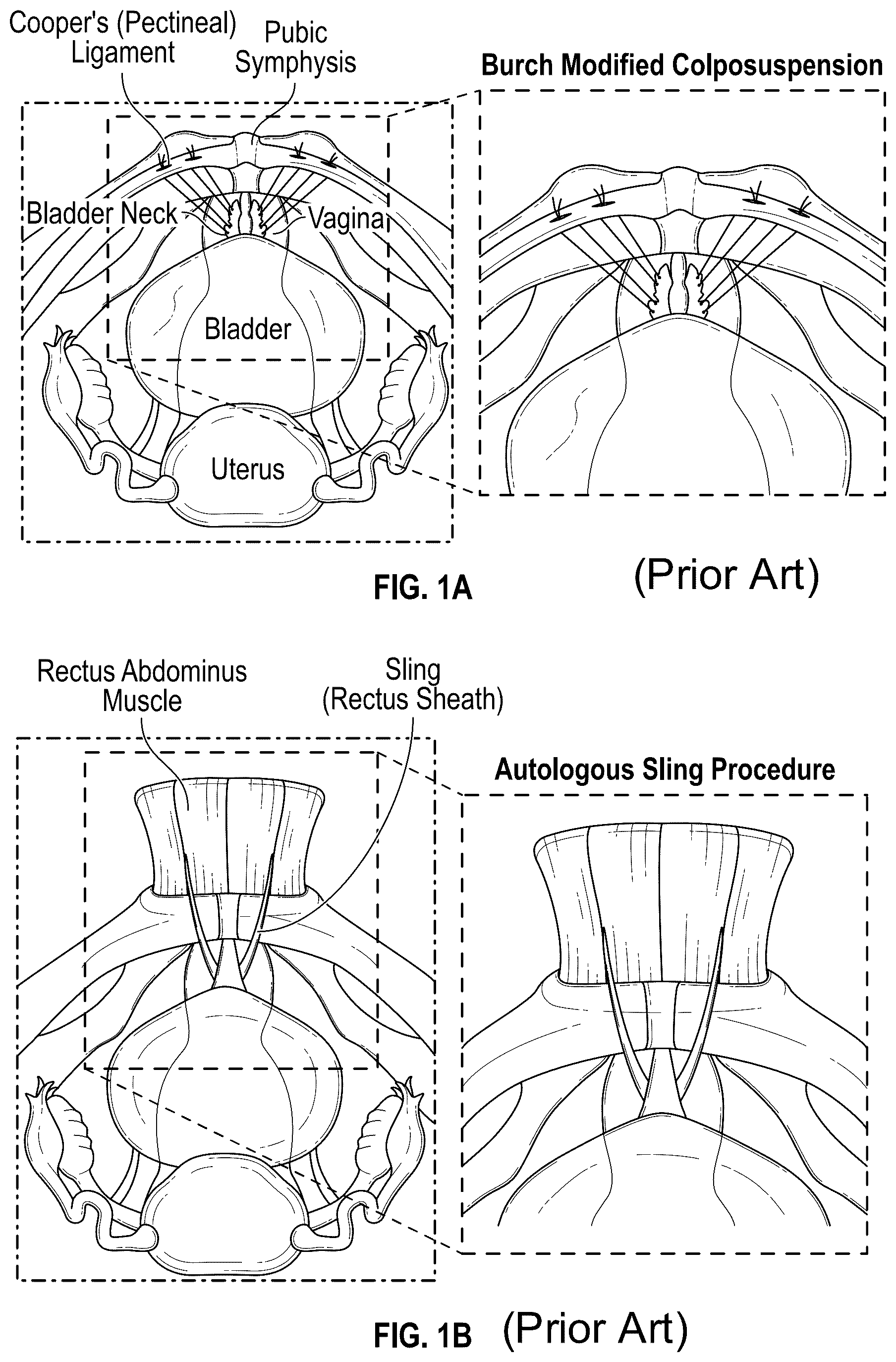 Patent US12167954 — Systems and methods for treating stress urinary incontinence — Figure 1