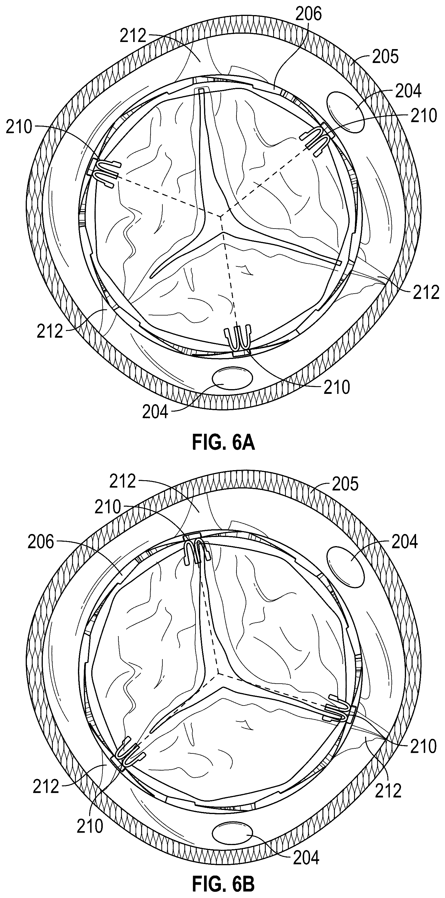 Patent US12167961 Figure 5 – Methods and systems for aligning a commissure of a prosthetic heart valve with a commissure of a native valve