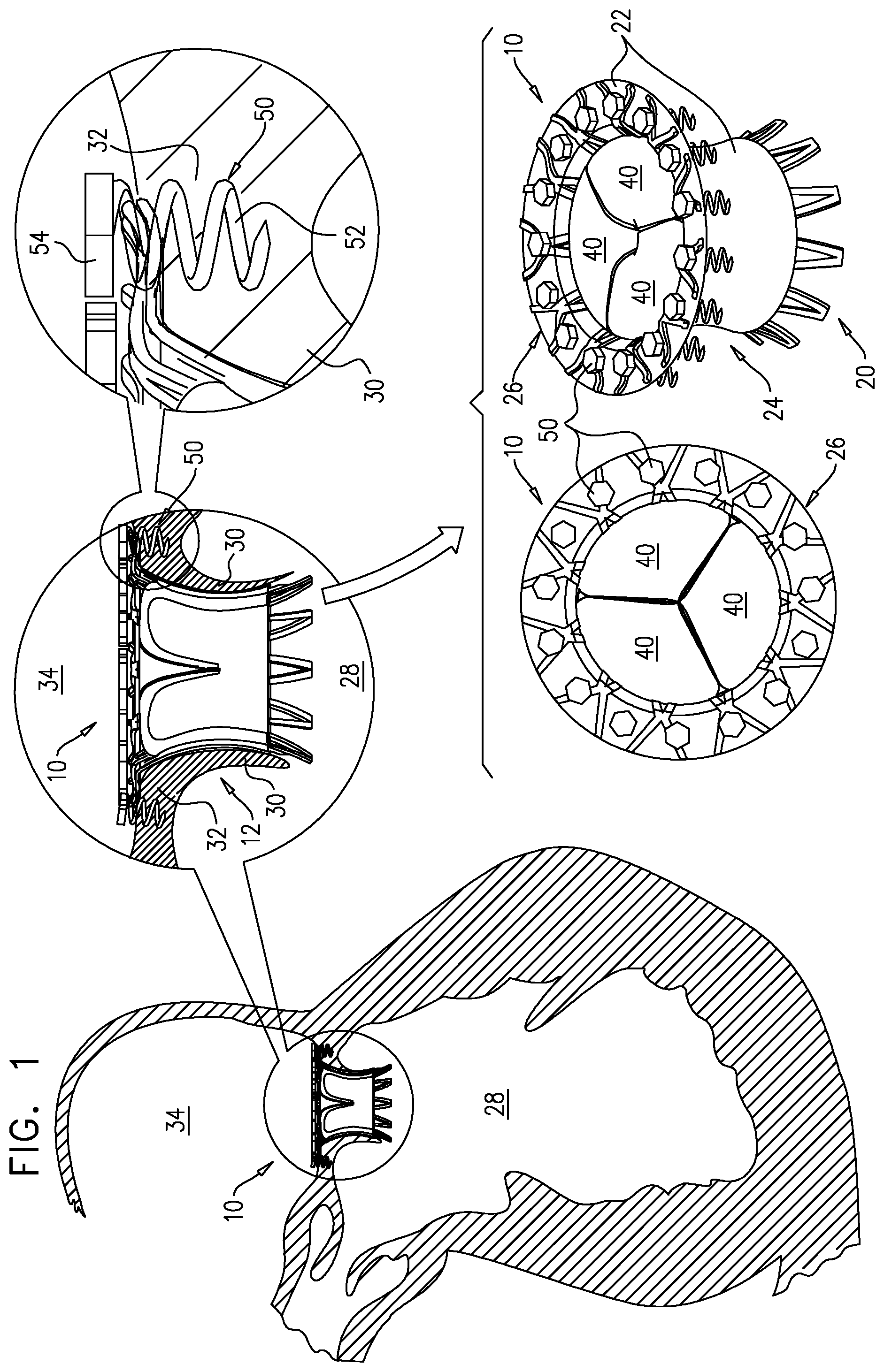 Patent US12167963 — Method for use at a heart valve — Figure 1
