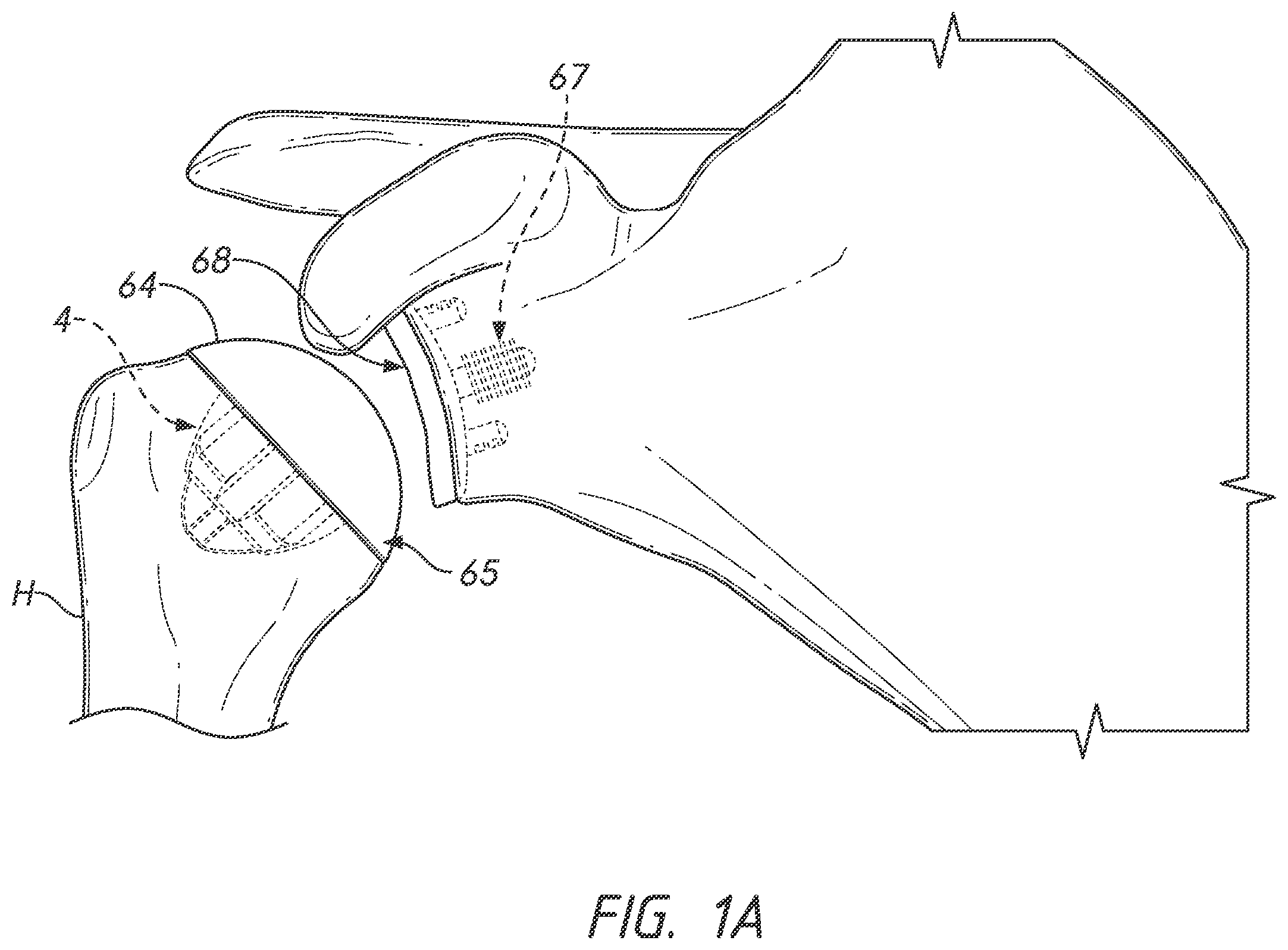 Patent US12167966 — Shoulder prosthesis components and assemblies — Figure 1