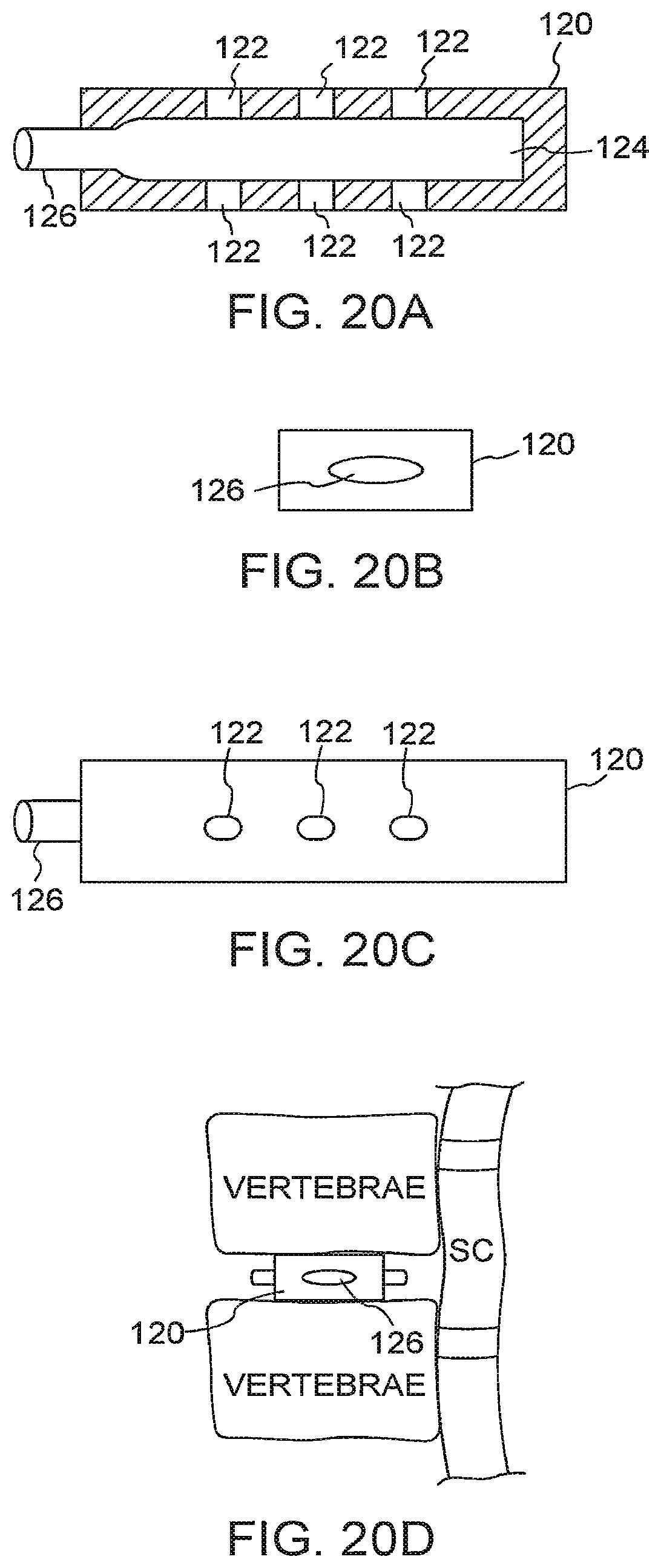 Patent US12167971 Figure 12 – Bone graft delivery devices, systems and kits