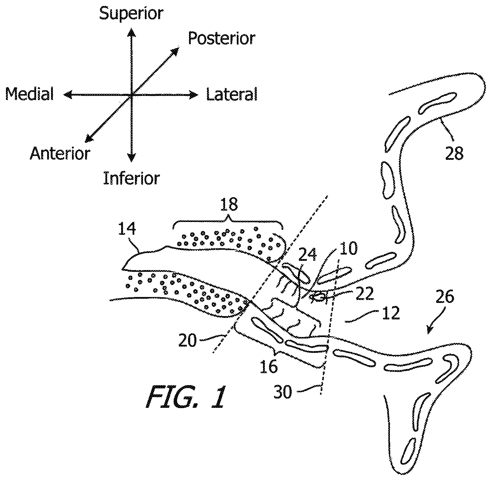 Patent US12174014 — Canal hearing device sizer tools, systems and methods — Figure 1