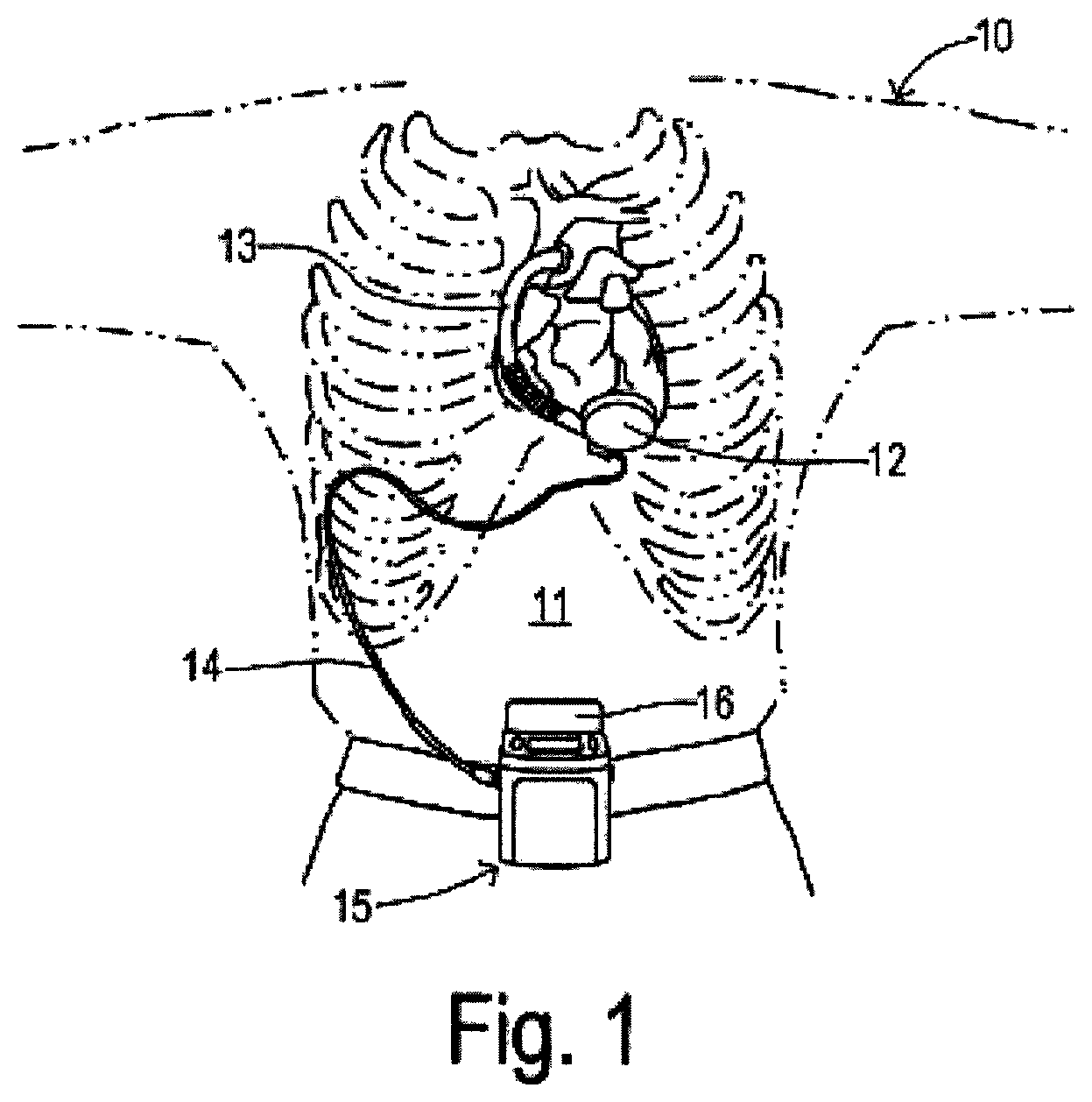 Patent US12297836 — Alternating pump gaps — Figure 1