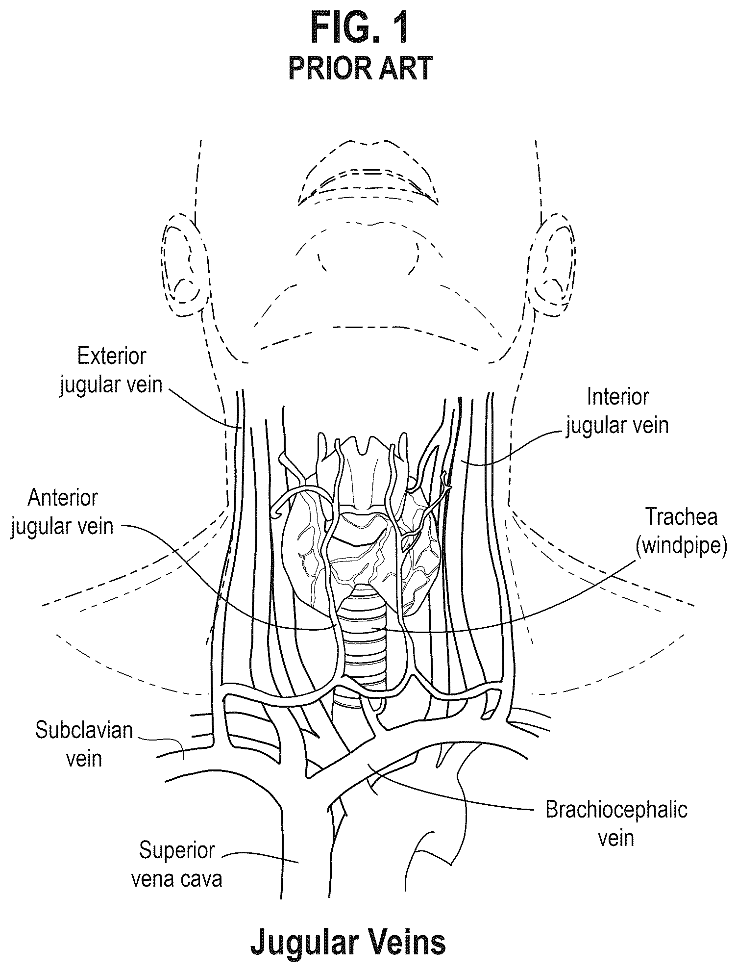 Patent US12302959 — Neck laceration prevention device — Figure 1