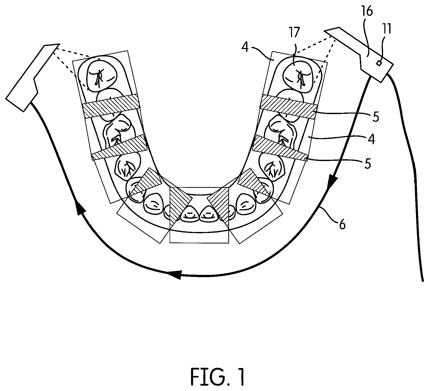 Patent US12303110 — Method and system for guiding an intra-oral scan — Figure 1