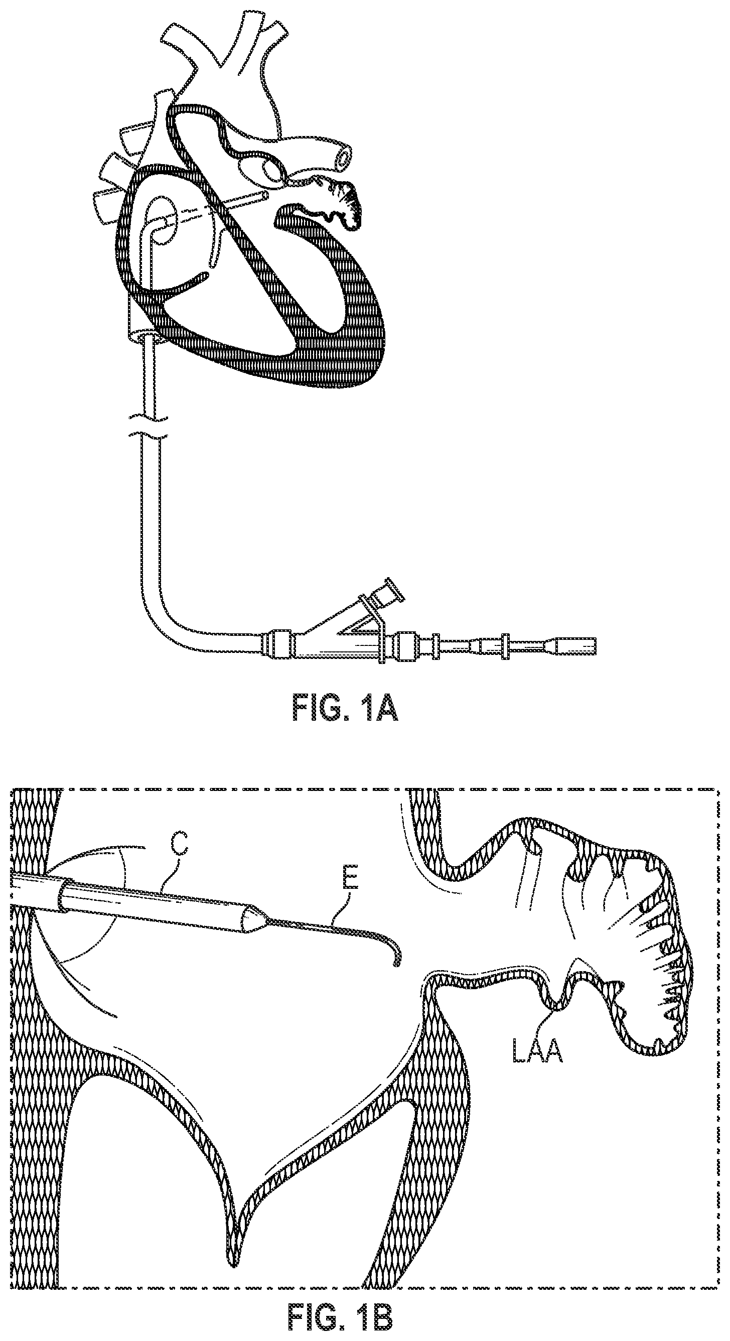 Patent US12303116 — Devices, systems, and methods for occluding cavities within the body — Figure 1