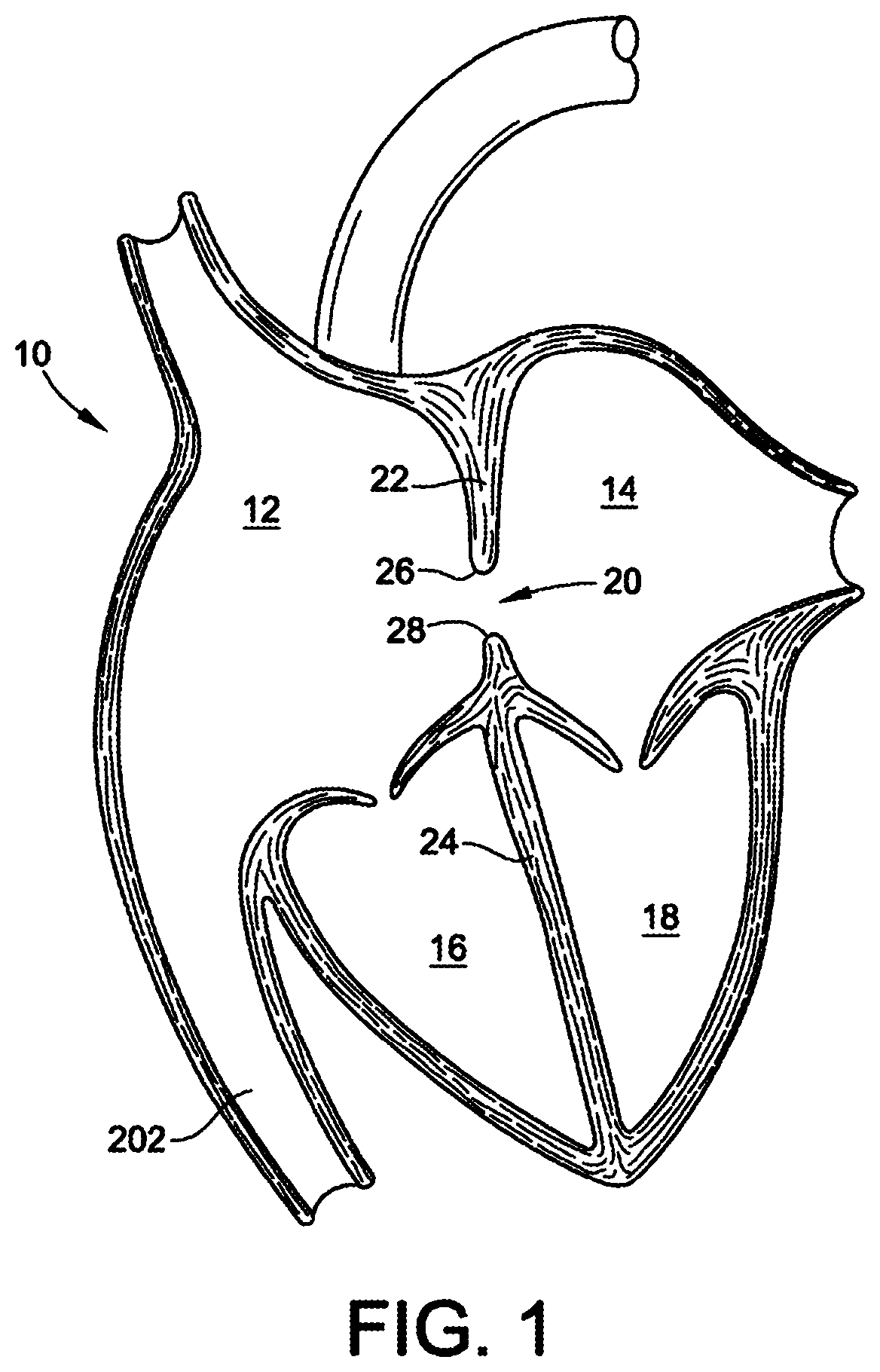 Patent US12303117 — Asymmetric occluder device — Figure 1