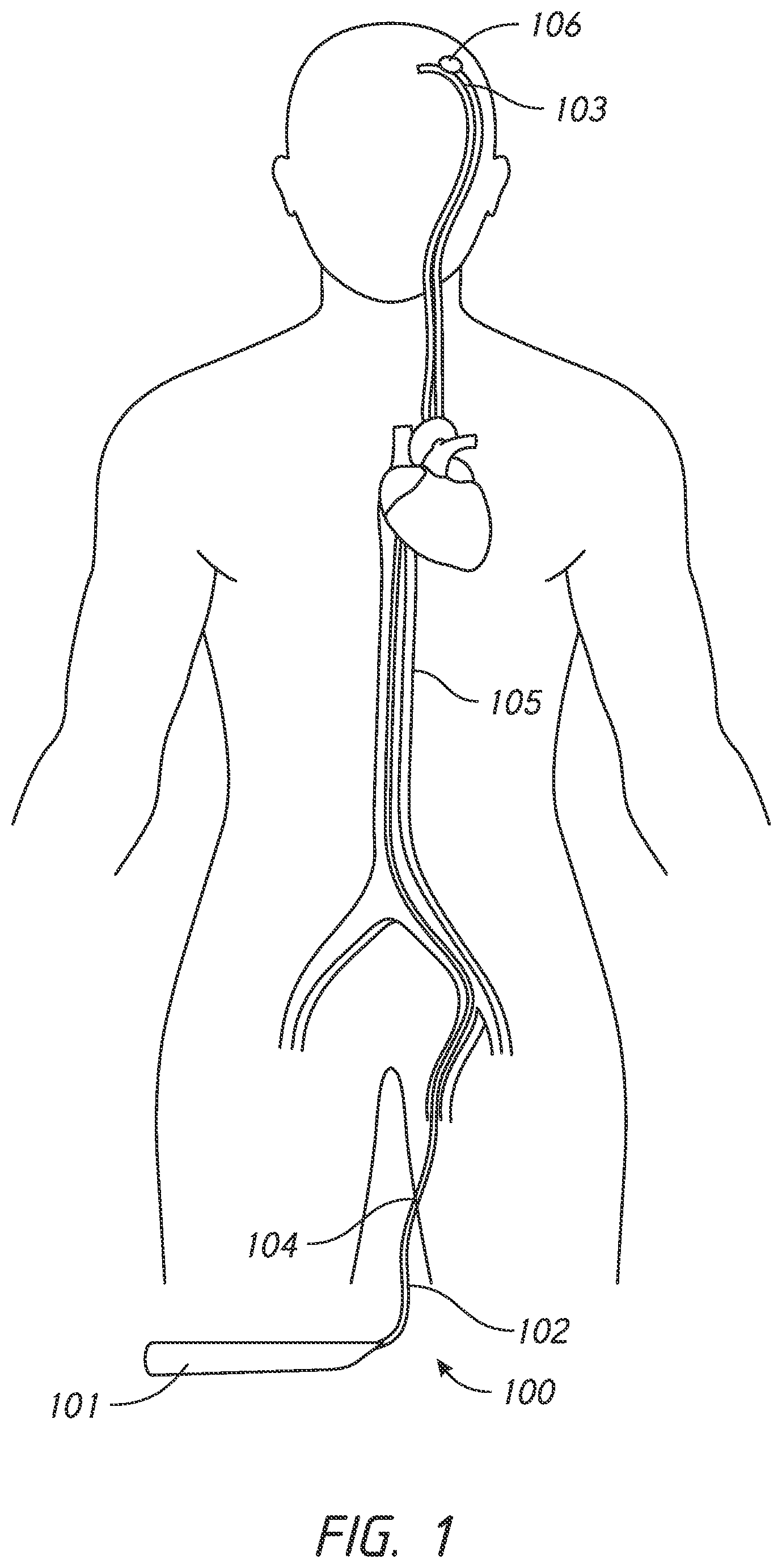 Patent US12303136 Figure 1 – System and methods for embolized occlusion of neurovascular aneurysms