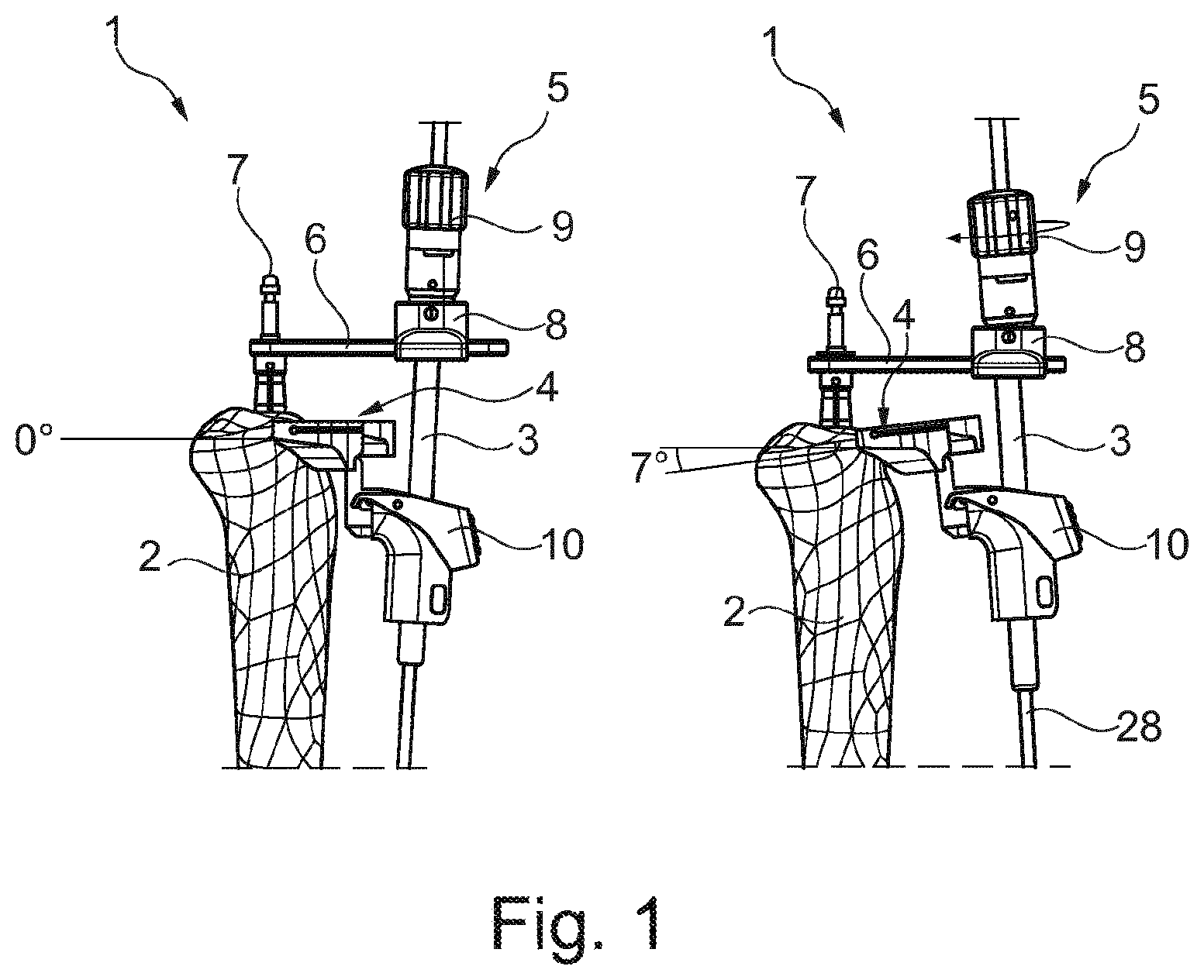 Patent US12303142 — Intramedullary tibia alignment system — Figure 1
