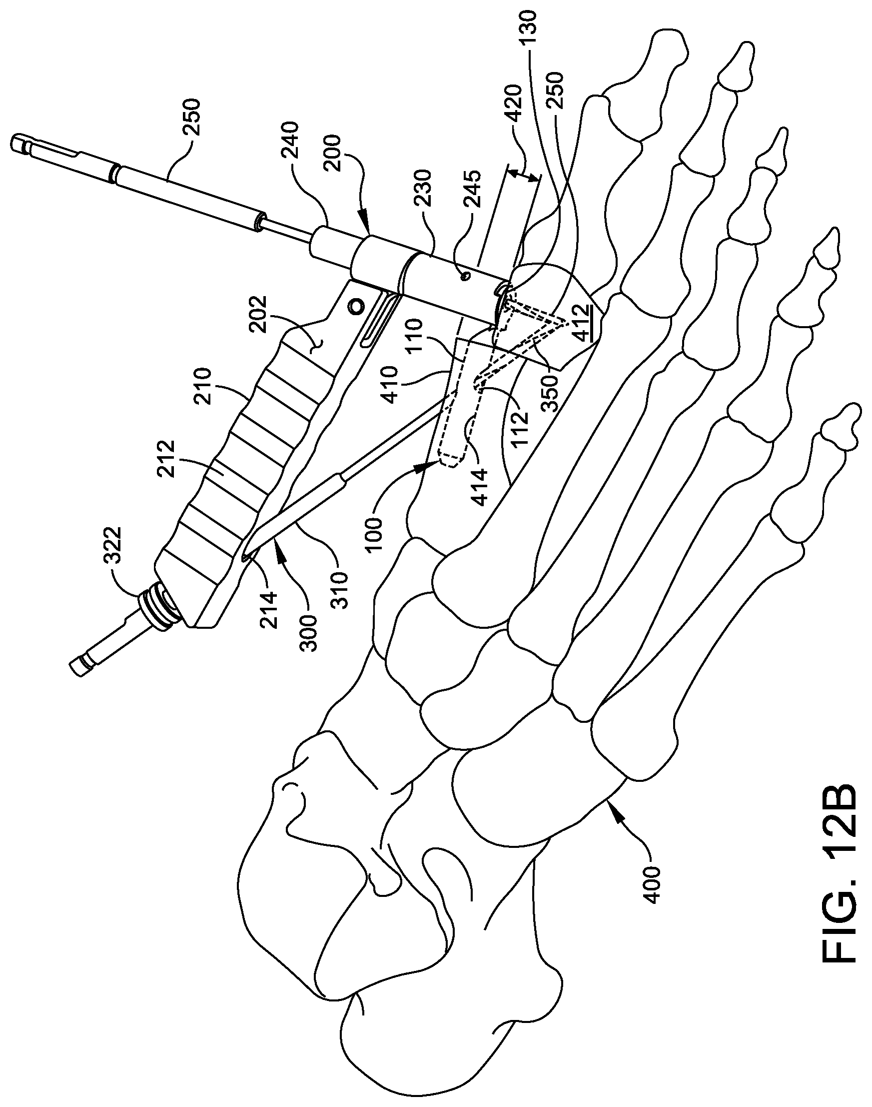 Patent US12303174 Figure 8 – Implant with intramedullary portion and variable angle extramedullary portion
