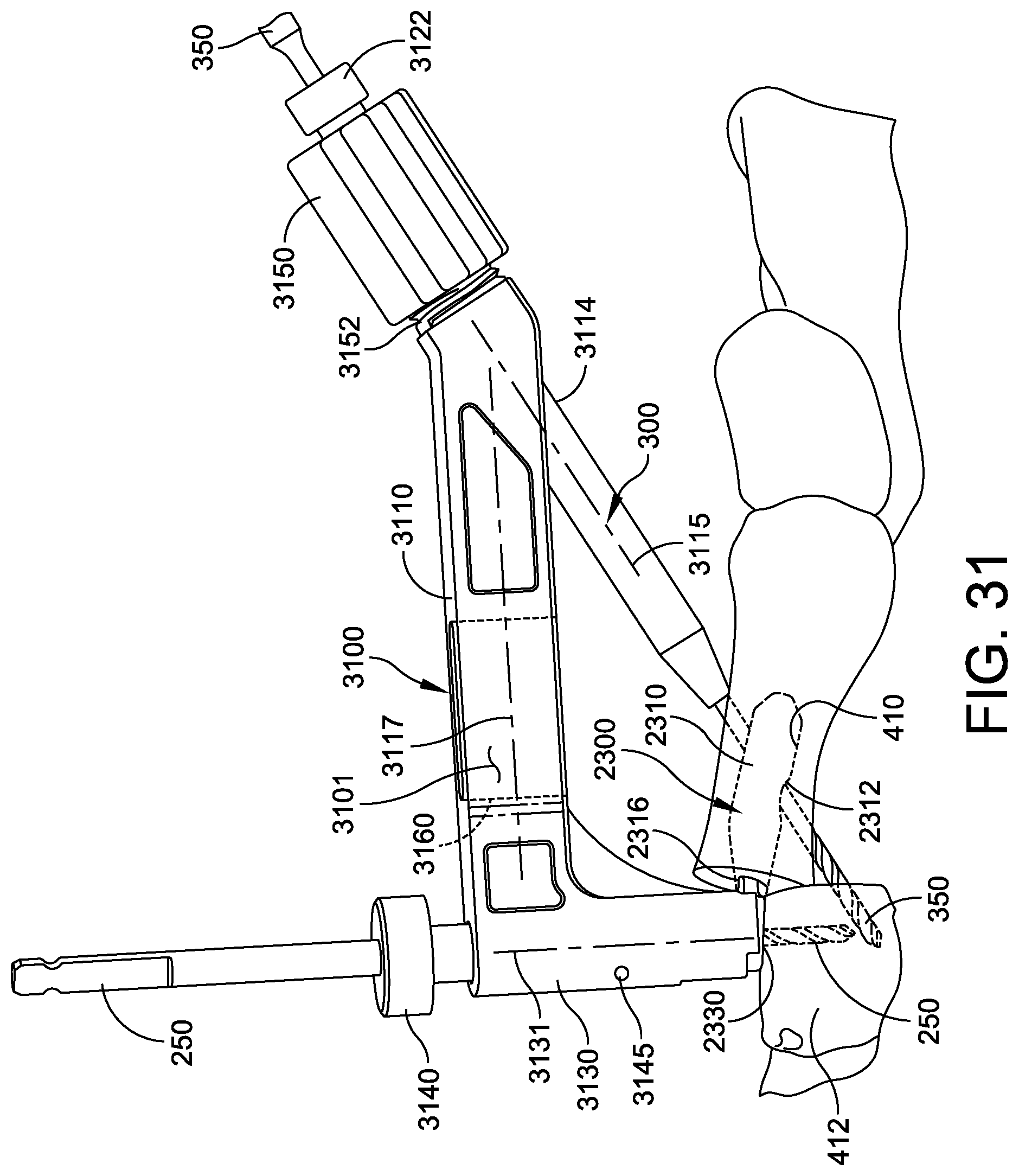 Patent US12303174 Figure 17 – Implant with intramedullary portion and variable angle extramedullary portion
