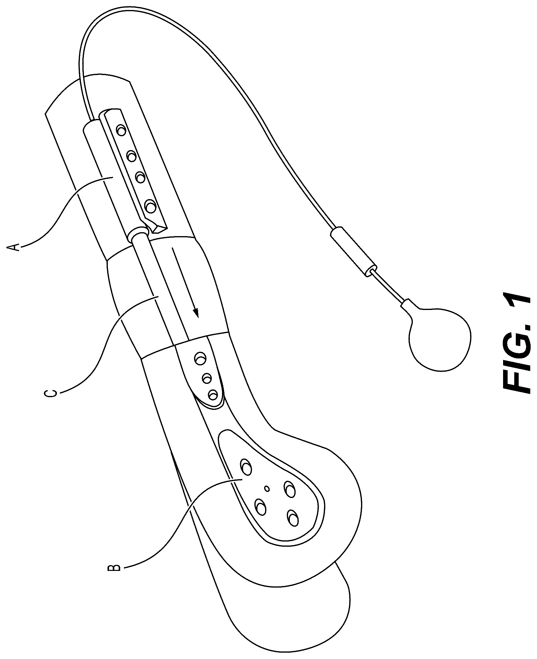 Patent US12303175 — Extramedullary internal bone lengthening and fixation device with dynamic axial stabilization — Figure 1